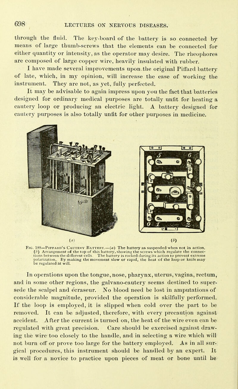 through the fluid. The key-board of the battery is so connected by- means of large thumb-screws that the elements can be connected for either quantity or intensity, as the operator may desire. The rheophores are composed of large copi)er wire, heavily insulated with rubber. I have made several improvements upon,the original Piffard battery of late, which, in my opinion, will increase the ease of working the instrument. They are not, as yet, fully perfected. It may be advisable to again impress upon 3-ou the fact that batteries designed for ordinarj- medical purposes are totally unfit for heating a cautery loop or producing an electric light. A batterj^ designed for cautery purposes is also totally unfit for other purposes in medicine. () (i) Fig. 18S—Piffakd's Cautery Battery.—(a) The battery as suspended when not in action. (/') Arrangement of the top of this battery, showing the screws which re<;ulaie the connec- tions between the different cells. I'he battery is roclicd during its action to prevent extreme polarization, by making the movement slow or rapid, the heat of the loop or knife may be regulated at will. In operations upon the tongue, nose, pharynx, uterus, vagina, rectum, and in some other regions, the galvano-cautery seems destined to super- sede the scalpel and ecraseur. No blood need be lost in amputations of considerable magnitude, provided the operation is skilfully performed. If the loop is employed, it is slipped when cold over the part to be removed. It can be adjusted, therefore, with every precaution against accident. After the current is turned on, the heat of the wire even can be regulated with great precision. Care should be exercised against draw- ing the wire too closely to the handle, and in selecting a wire which will not burn off or prove too large for the battery emploj'ed. As in all sur- gical procedures, this instrument should be handled by an expert. It is well for a novice to practice upon pieces of meat or bone until he