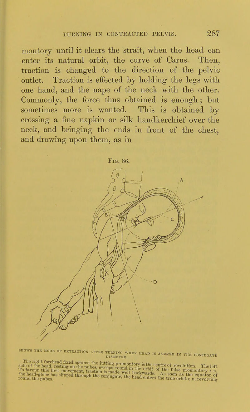 montory until it clears the strait, wlien the head can enter its natural orbit, the curve of Carus. Then, traction is changed to the direction of the pelvic outlet. Traction is effected by holding the legs with one hand, and the nape of the neck with the other. Commonly, the force thus obtained is enough; but sometimes more is wanted. This is obtained by crossing a fine napkin or silk handkerchief over the neck, and bringing the ends in front of the chest, and drawing upon them, as in Pig. 86. snow. ™b moob o. ™c.:ok ~o w„k. „..o . ..m„k. ,k rn. co.v.uo.™ sia?on'g^*he^frtfi^lXtu*^^^^ Tholeft To favom- this first ^^ov.mentMi^ntXAT^tnha^^^ °*a'' ^'^'^ P^^^onto.y A b. the head-Blobe has sUpped thi-ouffh the coniumtp ft,; 1^0!!^ i. ' , ^^<^ equator of round the pubes. tiie conjugate, the head enters the true orbit c d, revolving