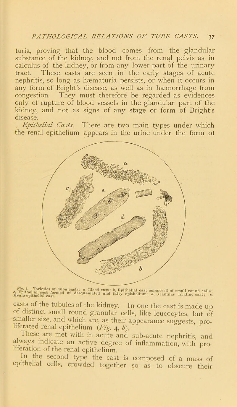 tuna, proving that the blood comes from the glandular substance of the kidney, and not from the renal pelvis as in calculus of the kidney, or from any lower part of the urinary tract. These casts are seen in the early stages of acute nephritis, so long as haematuria persists, or when it occurs in any form of Bright’s disease, as well as in haemorrhage from congestion. They must therefore be regarded as evidences only of rupture of blood vessels in the glandular part of the kidney, and not as signs of any stage or form of Bright’s disease. Epithelial Casts. There are two main types under which the renal epithelium appears in the urine under the form ol c %4ellIirJwSfSLtSfe ^asis: B1°°d,cast; Epithelial cast composed of small round cells; Hyafmepithbial cast d * destlaamate<1 and la‘ty epithelium; d, Granular hyaline cast; «, casts of the tubules of the kidney. In one the cast is made up of distinct small round granular cells, like leucocytes, but of smaller size, and which are, as their appearance suggests, pro- liferated renal epithelium {Fig. 4, b). These aie met with in acute and sub-acute nephritis, and always indicate an active degree of inflammation, with pro- liferation of the renal epithelium. In the second type the cast is composed of a mass of epithelial cells, crowded together so as to obscure their