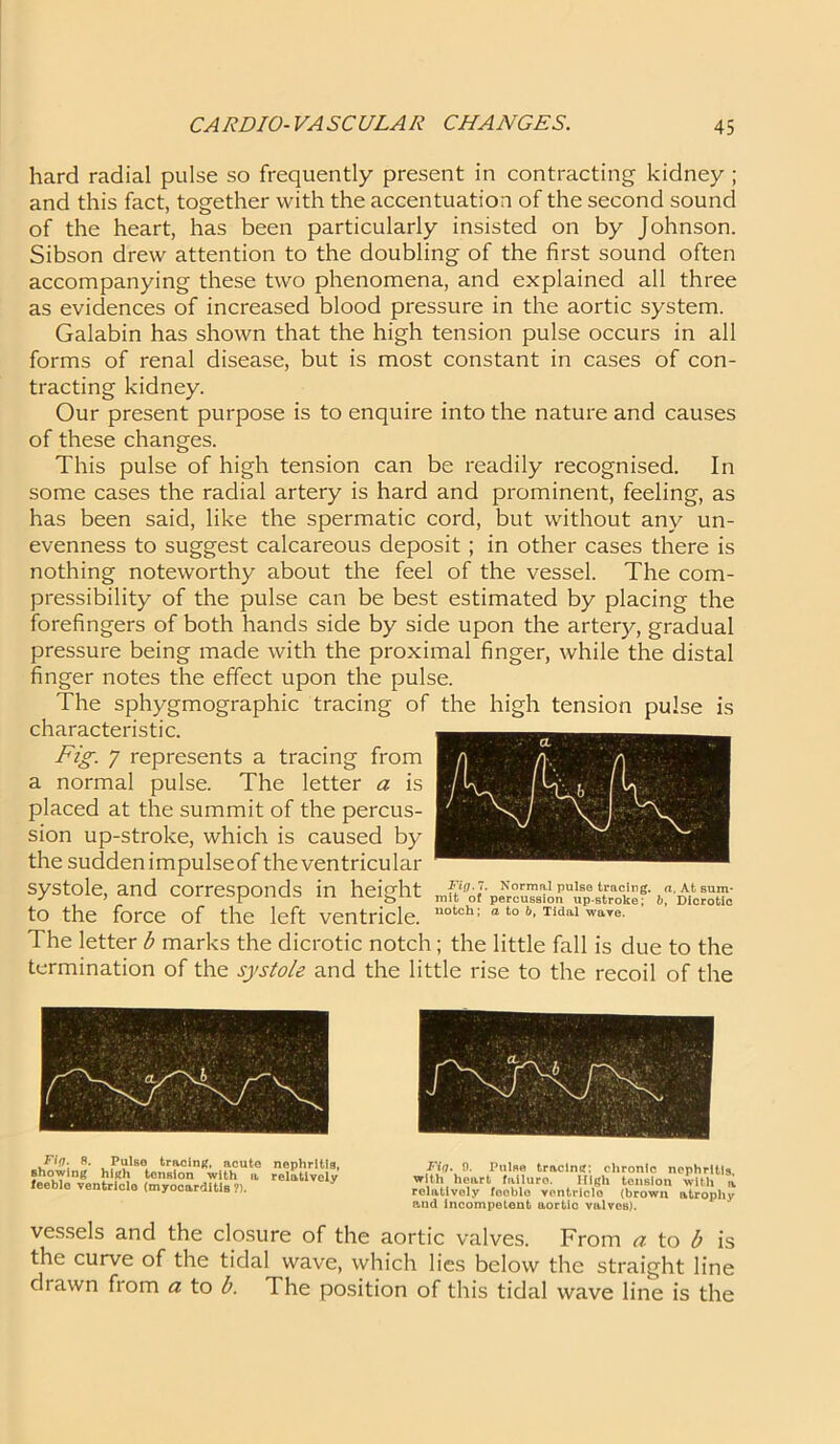 hard radial pulse so frequently present in contracting kidney ; and this fact, together with the accentuation of the second sound of the heart, has been particularly insisted on by Johnson. Sibson drew attention to the doubling of the first sound often accompanying these two phenomena, and explained all three as evidences of increased blood pressure in the aortic system. Galabin has shown that the high tension pulse occurs in all forms of renal disease, but is most constant in cases of con- tracting kidney. Our present purpose is to enquire into the nature and causes of these changes. This pulse of high tension can be readily recognised. In some cases the radial artery is hard and prominent, feeling, as has been said, like the spermatic cord, but without any un- evenness to suggest calcareous deposit ; in other cases there is nothing noteworthy about the feel of the vessel. The com- pressibility of the pulse can be best estimated by placing the forefingers of both hands side by side upon the artery, gradual pressure being made with the proximal finger, while the distal finger notes the effect upon the pulse. The sphygmographic tracing of the high tension pulse is characteristic. Fig. 7 represents a tracing from a normal pulse. The letter a is placed at the summit of the percus- sion up-stroke, which is caused by the sudden impulseof the ventricular systole, and corresponds in height to the force of the left ventricle. The letter b marks the dicrotic notch ; the little fall is due to the termination of the systole and the little rise to the recoil of the Fig.7. formal pulse tracing, a. At sum- mit of percussion upstroke; b, Dicrotic notch; a to b, Tidal wave. Fig. 8. Pulso tracing, acute nephritis, showing high tension with a relatively feeble ventriclo (myocarditis ?). Fig. 9. Pulse tracing; chronic nephritis with heart failure. High tension with a relatively fooblo ventriclo (brown atrophy p-nd incompetent aortic valves). vessels and the closure of the aortic valves. From a to b is the curve of the tidal wave, which lies below the straight line drawn from a to b. 1 he position of this tidal wave line is the