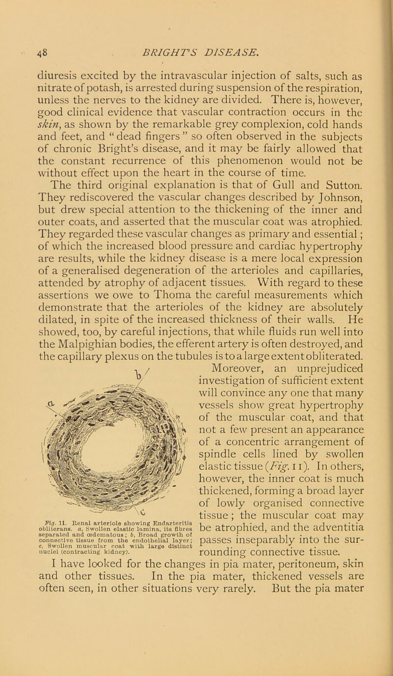 diuresis excited by the intravascular injection of salts, such as nitrate of potash, is arrested during suspension of the respiration, unless the nerves to the kidney are divided. There is, however, good clinical evidence that vascular contraction occurs in the skin, as shown by the remarkable grey complexion, cold hands and feet, and “ dead fingers ” so often observed in the subjects of chronic Bright’s disease, and it may be fairly allowed that the constant recurrence of this phenomenon would not be without effect upon the heart in the course of time. The third original explanation is that of Gull and Sutton. They rediscovered the vascular changes described by Johnson, but drew special attention to the thickening of the inner and outer coats, and asserted that the muscular coat was atrophied. They regarded these vascular changes as primary and essential; of which the increased blood pressure and cardiac hypertrophy are results, while the kidney disease is a mere local expression of a generalised degeneration of the arterioles and capillaries, attended by atrophy of adjacent tissues. With regard to these assertions we owe to Thoma the careful measurements which demonstrate that the arterioles of the kidney are absolutely dilated, in spite of the increased thickness of their walls. He showed, too, by careful injections, that while fluids run well into the Malpighian bodies, the efferent artery is often destroyed, and the capillary plexus on the tubules is to a large extent obliterated. I have looked for the changes in pia mater, peritoneum, skin and other tissues. In the pia mater, thickened vessels are often seen, in other situations very rarely. But the pia mater Fig. 11. Renal arteriole showing Endarteritis obliterans, a, Swollen elastic lamina, its fibres separated and oedematous; b, Broad growth of connective tissue from the endothelial layer; o, Swollen muscular coat with large distinct nuclei (contracting kidney). Moreover, an unprejudiced investigation of sufficient extent will convince any one that many vessels show great hypertrophy of the muscular coat, and that not a few present an appearance of a concentric arrangement of spindle cells lined by swollen elastic tissue {Fig. 11). In others, however, the inner coat is much thickened, forming a broad layer of lowly organised connective tissue; the muscular coat may be atrophied, and the adventitia passes inseparably into the sur- rounding connective tissue.
