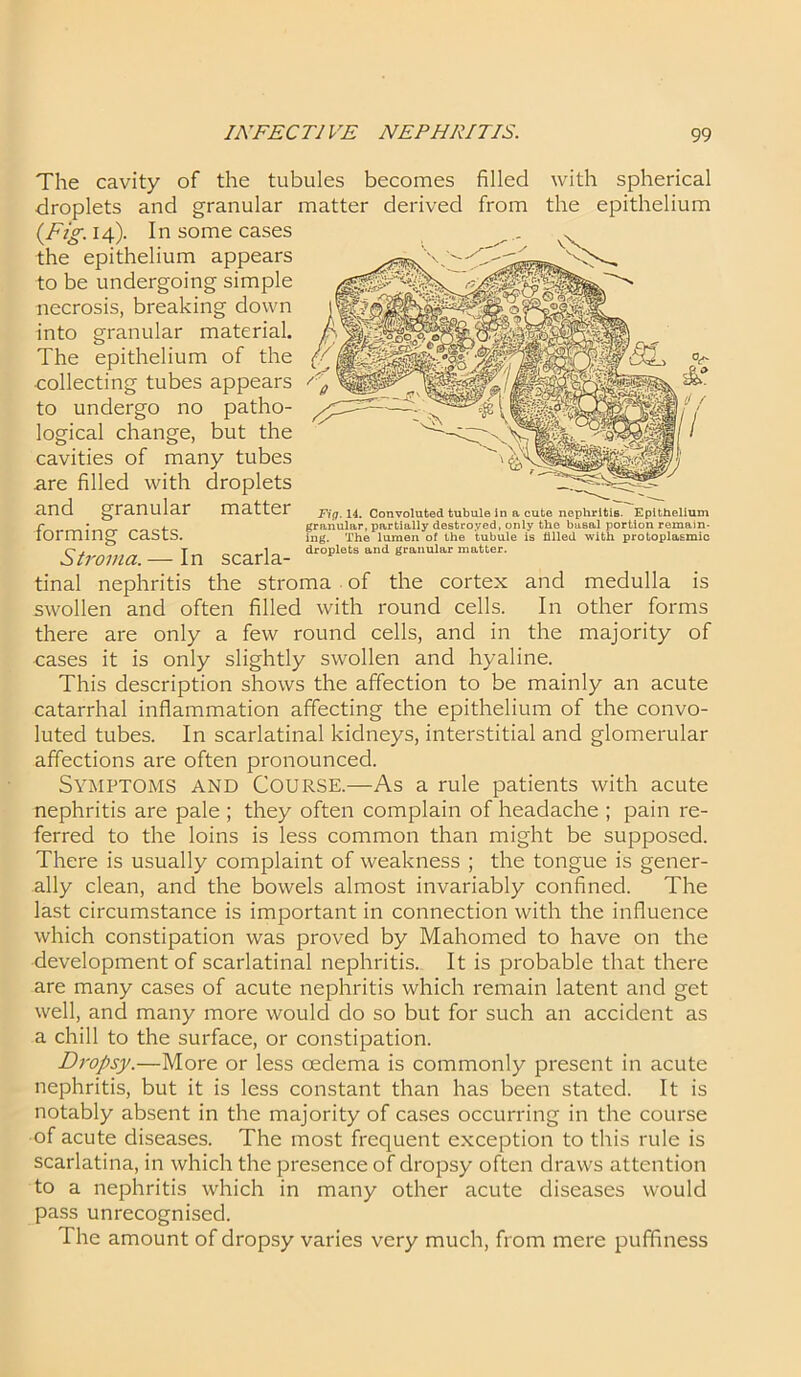 Fig. 14. Convoluted tubule in a cute nephritis. Epithelium granular, partially destroyed, only the busal portion remain- ing. The lumen of the tubule is tilled with protoplasmic and medulla is In other forms the majority of The cavity of the tubules becomes filled with spherical droplets and granular matter derived from the epithelium {Fig. 14). In some cases the epithelium appears to be undergoing simple necrosis, breaking down into granular material. The epithelium of the collecting tubes appears to undergo no patho- logical change, but the cavities of many tubes are filled with droplets and granular matter forming casts. O, T 1 „ droplets and granular matter. Stroma.— In scarla- tinal nephritis the stroma of the cortex swollen and often filled with round cells, there are only a few round cells, and in cases it is only slightly swollen and hyaline. This description shows the affection to be mainly an acute catarrhal inflammation affecting the epithelium of the convo- luted tubes. In scarlatinal kidneys, interstitial and glomerular affections are often pronounced. Symptoms and Course.—As a rule patients with acute nephritis are pale ; they often complain of headache ; pain re- ferred to the loins is less common than might be supposed. There is usually complaint of weakness ; the tongue is gener- ally clean, and the bowels almost invariably confined. The last circumstance is important in connection with the influence which constipation was proved by Mahomed to have on the development of scarlatinal nephritis. It is probable that there are many cases of acute nephritis which remain latent and get well, and many more would do so but for such an accident as a chill to the surface, or constipation. Dropsy.—More or less oedema is commonly present in acute nephritis, but it is less constant than has been stated. It is notably absent in the majority of cases occurring in the course of acute diseases. The most frequent exception to this rule is scarlatina, in which the presence of dropsy often draws attention to a nephritis which in many other acute diseases would pass unrecognised. I he amount of dropsy varies very much, from mere puffiness