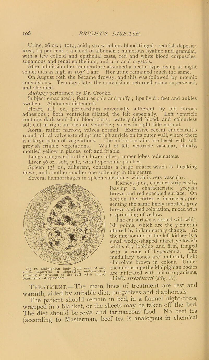 Urine, 26 oz.; 1014, acid ; straw-colour, blood-tinged ; reddish deposit; urea, 1 ‘4 per cent. ; a cloud of albumen ; numerous hyaline and granular, with a few colloid and epithelial casts, red and white blood corpuscles, squamous and renal epithelium, and uric acid crystals. After admission her temperature assumed a hectic type, rising at night sometimes as high as 103° Fahr. Her urine remained much the same. On August 10th she became drowsy, and this was followed by uraemic convulsions. Two days later the convulsions returned, coma supervened, and she died. Autopsy performed by Dr. Crooke. Subject emaciated ; features pale and puffy ; lips livid ; feet and ankles swollen. Abdomen distended. Heart, 1 iL oz., pericardium universally adherent by old fibrous adhesions ; both ventricles dilated, the left especially. Left ventricle contains dark semi-fluid blood clots ; watery fluid blood, and colourless soft clot in right auricle and ventricle ; valves in right side normal. Aorta, rather narrow, valves normal. Extensive recent endocai'ditis round mitral valve extending into left auricle on its outer wall, where there is a large patch of vegetations. The mitral curtains are beset with soft greyish friable vegetations. Wall of left ventricle vascular, cloudy, mottled yellow in places, soft and friable. Lungs congested in their lower lobes ; upper lobes cedematous. Liver 56 oz., soft, pale, with hypenemic patches. Spleen 13^ oz., adherent, contains a large infarct which is breaking down, and another smaller one softening in the centre. Several haemorrhages in spleen substance, which is very vascular. Kidneys 9 oz., capsules strip easily, leaving a characteristic greyish brown and red speckled surface. On section the cortex is increased, pre- senting the same finely mottled, grey brown and red coloration, mixed with a sprinkling of yellow. The cut surface is dotted with whit- ish points, which are the glomeruli altered by inflammatory change. At the inferior end of the left kidney is a small wedge-shaped infarct, yellowish white, dry looking and firm, fringed with a zone of hyperaemia. The medullary cones are uniformly light chocolate brown in colour. Under the microscope the Malpighian bodies are infiltrated with micro-organisms, chiefly streptococci (Fig. 17). Treatment.—The main lines of treatment are rest and warmth, aided by suitable diet, purgatives and diaphoresis. The patient should remain in bed, in a flannel night-dress, wrapped in a blanket, or the sheets may be taken off the bed. The diet should be milk and farinaceous food. No beef tea (according to Masterman, beef tea is analogous in chemical Fig. 17. Malpighian Body frera case of sub- acute nephritis in ulcerative endocarditis, showing infiltration of the tuft with micro- organisms (streptococci).