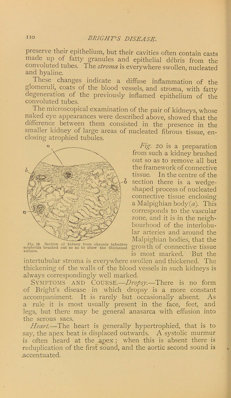 preseive their epithelium, but their cavities often contain casts made up of fatty granules and epithelial debris from the convoluted tubes. The stroma is everywhere swollen, nucleated and hyaline. These _ changes indicate a diffuse inflammation of the glomeruli, coats of the blood vessels, and stroma, with fatty degeneration of the previously inflamed epithelium of the convoluted tubes. The mici oscopical examination of the pair of kidneys, whose naked eye appearances were described above, showed that the difference between them consisted in the presence in the smaller kidney of large areas of nucleated fibrous tissue, en- Fig. 20 is a preparation from such a kidney brushed out so as to remove all but the framework of connective tissue. In the centre of the section there is a wedge- shaped process of nucleated connective tissue enclosing a Malpighian body (a). This corresponds to the vascular zone, and it is in the neigh- bourhood of the interlobu- lar arteries and around the Malpighian bodies, that the nephritis brushed out so as to show the thickened 'gl OYY til Oi COlinCCtlVC tlSSUG is most marked. But the intertubular stroma is everywhere swollen and thickened. The thickening of the walls of the blood vessels in such kidneys is always correspondingly well marked. Symptoms and Course.—Dropsy.—There is no form ■of Bright’s disease in which dropsy is a more constant accompaniment. It is rarely but occasionally absent. As a rule it is most usually present in the face, feet, and legs, but there may be general anasarca with effusion into the serous sacs. Heart.—The heart is generally hypertrophied, that is to say, the apex beat is displaced outwards. A systolic murmur is often heard at the apex ; when this is absent there is reduplication of the first sound, and the aortic second sound is .accentuated.