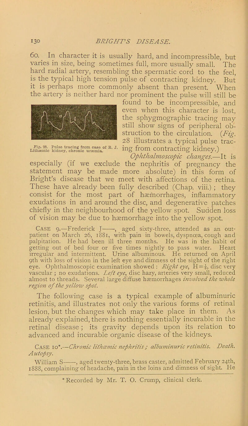 6o. In character it is usually hard, and incompressible, but varies in size, being sometimes full, more usually small. The hard radial artery, resembling the spermatic cord to the feel, is the typical high tension pulse of contracting kidney. But it is perhaps more commonly absent than present. When the artery is neither hard nor prominent the pulse will still be found to be incompressible, and even when this character is lost, the sphygmographic tracing may still show signs of peripheral ob- struction to the circulation. {Fig. 28 illustrates a typical pulse trac- LS£yb»rr1E'J- ing from contracting kidney.) Ophthalmoscopic changes.—It is especially (if we exclude the nephritis of pregnancy the statement may be made more absolute) in this form of Bright’s disease that we meet with affections of the retina. These have already been fully described (Chap, viii.) ; they consist for the most part of haemorrhages, inflammatory exudations in and around the disc, and degenerative patches chiefly in the neighbourhood of the yellow spot. Sudden loss of vision may be due to haemorrhage into the yellow spot. Case 9.—Frederick J , aged sixty-three, attended as an out- patient on March 26, 1881, with pain in bowels, dyspnoea, cough and palpitation. He had been ill three months. He was in the habit of getting out of bed four or five times nightly to pass water. Heart irregular and intermittent. Urine albuminous. He returned on April 9th with loss of vision in the left eye and dimness of the sight of the right eye. Ophthalmoscopic examination showed : Right eye, H=T, disc very vascular ; no exudations. Left eye, disc hazy, arteries very small, reduced almost to threads. Several large diffuse haemorrhages involved the whole region of the yellow spot. The following case is a typical example of albuminuric retinitis, and illustrates not only the various forms of retinal lesion, but the changes which may take place in them. As already explained, there is nothing essentially incurable in the retinal disease ; its gravity depends upon its relation to advanced and incurable organic disease of the kidneys. Case 10*.—Chronic lithcemic nephritis ; albuminuric retinitis. Death. Autopsy. William S , aged twenty-three, brass caster, admitted February 24th, 1888, complaining of headache, pain in the loins and dimness of sight. He Recorded by Mr. T. O. Crump, clinical clerk.