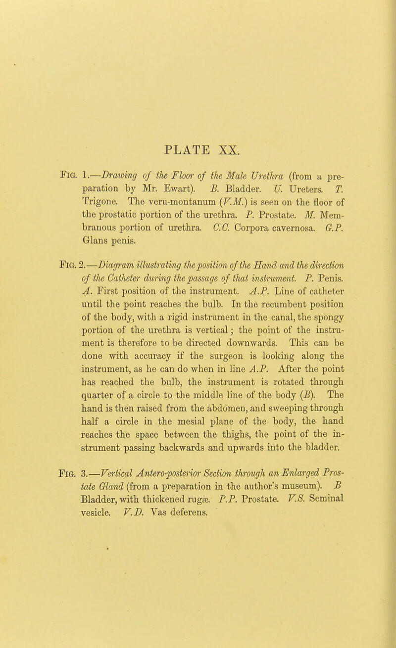 Fig. 1.—Drawing of the Floor of the Male Urethra (from a pre- paration by Mr. Ewart). B. Bladder. U. Ureters. T. Trigone. The veru-montanum {V.M.)\s seen on the floor of the prostatic portion of the urethra. P. Prostate. M. Mem- branous portion of urethra. C.C. Corpora cavernosa. G.P. Glans penis. Fig. 2.—Diagram illustrating the position of the Hand and the direction of the Catheter during the passage of that instrument. P. Penis. A. First position of the instrument. A.P. Line of catheter until the point reaches the bulb. In the recumbent position of the body, with a rigid instrument in the canal, the spongy portion of the urethra is vertical; the point of the instru- ment is therefore to be directed downwards. This can be done with accuracy if the surgeon is looking along the instrument, as he can do when in line A.P. After the point has reached the bulb, the instrument is rotated through quarter of a circle to the middle line of the body {B). The hand is then raised from the abdomen, and sweeping through half a circle in the mesial plane of the body, the hand reaches the space between the thighs, the point of the in- strument passing backwards and upwards into the bladder. Fig. 3.—Vertical Antero-posterior Section through an Enlarged Pros- tate Gland (from a preparation in the author's museum). B Bladder, with thickened rugse. P.P. Prostate. F!*?. Seminal vesicle. V.D. Vas deferens.