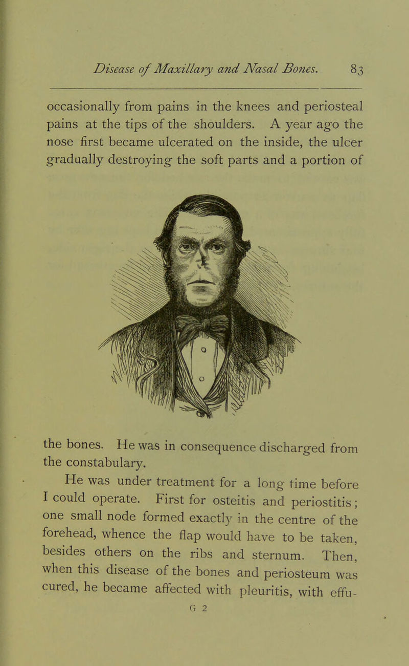 occasionally from pains in the knees and periosteal pains at the tips of the shoulders. A year ago the nose first became ulcerated on the inside, the ulcer gradually destroying the soft parts and a portion of the bones. He was in consequence discharged from the constabulary. He was under treatment for a long time before I could operate. First for osteitis and periostitis; one small node formed exactly in the centre of the forehead, whence the flap would have to be taken, besides others on the ribs and sternum. Then, when this disease of the bones and periosteum was cured, he became affected with pleuritis, with effu- G 2