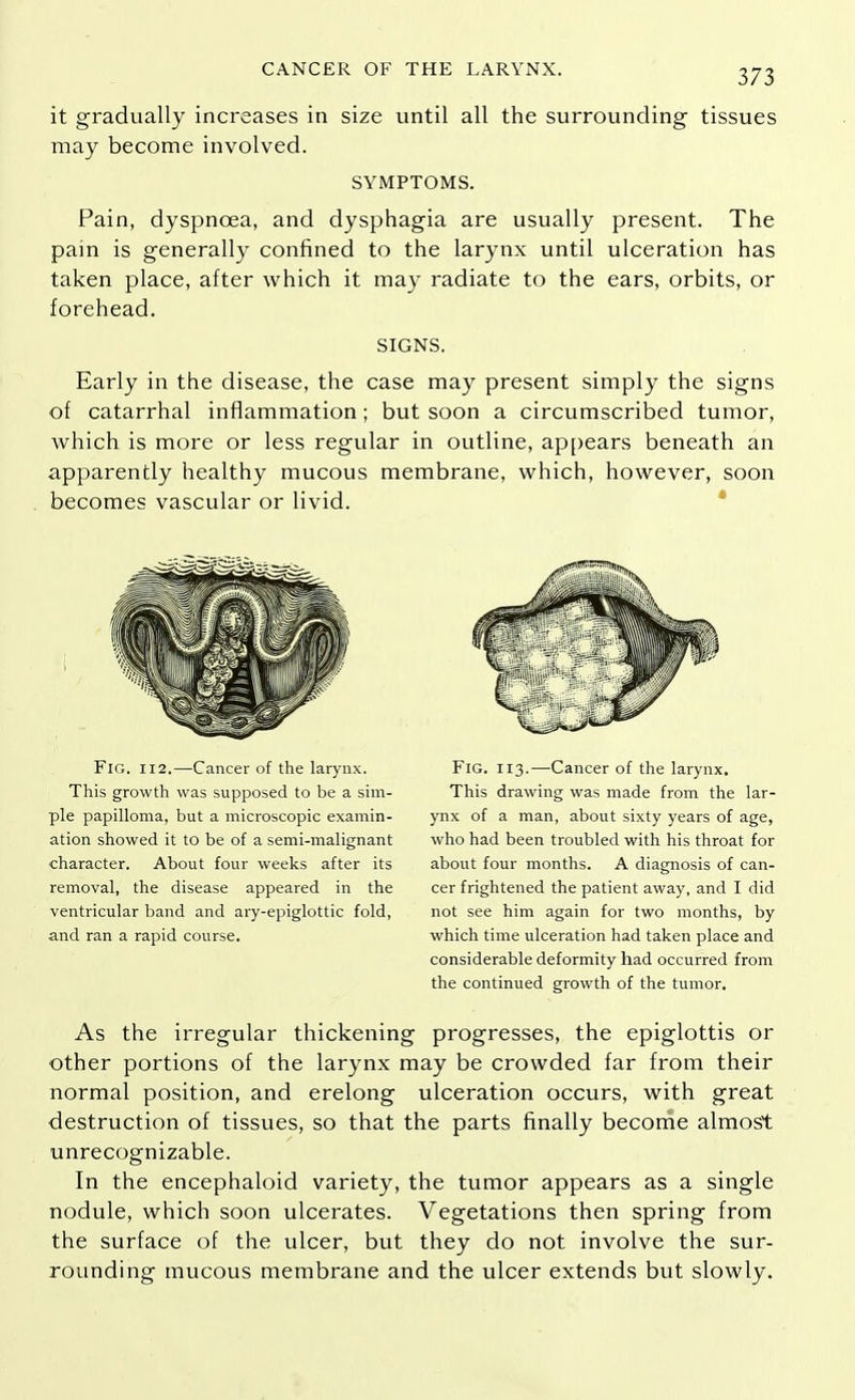 it gradually increases in size until all the surrounding tissues may become involved. SYMPTOMS. Pain, dyspnoea, and dysphagia are usually present. The pain is generally confined to the larynx until ulceration has taken place, after which it may radiate to the ears, orbits, or forehead. SIGNS. Early in the disease, the case may present simply the signs of catarrhal inflammation; but soon a circumscribed tumor, which is more or less regular in outline, appears beneath an apparently healthy mucous membrane, which, however, soon becomes vascular or livid. Fig. 112.—Cancer of the larynx. This growth was supposed to be a sim- ple papilloma, but a microscopic examin- ation showed it to be of a semi-malignant character. About four weeks after its removal, the disease appeared in the ventricular band and ary-epiglottic fold, and ran a rapid course. FlG. 113.—Cancer of the larynx. This drawing was made from the lar- ynx of a man, about sixty years of age, who had been troubled with his throat for about four months. A diagnosis of can- cer frightened the patient away, and I did not see him again for two months, by which time ulceration had taken place and considerable deformity had occurred from the continued growth of the tumor. As the irregular thickening progresses, the epiglottis or other portions of the larynx may be crowded far from their normal position, and erelong ulceration occurs, with great destruction of tissues, so that the parts finally become almost unrecognizable. In the encephaloid variety, the tumor appears as a single nodule, which soon ulcerates. Vegetations then spring from the surface of the ulcer, but they do not involve the sur- rounding mucous membrane and the ulcer extends but slowly.