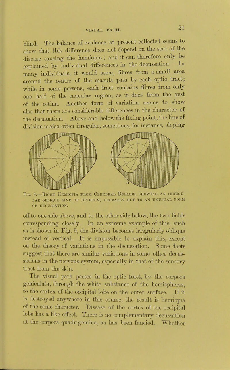 blind. The balance of evidence at present collected seems to show that this difference does not depend on the seat of the disease causing the hemiopia ; and it can therefore^ only he explained by individual differences in the decussation. In many incHviduals, it would seem, fibres from a small area ai-oimd the centre of the macula pass by each optic tract; while in some persons, each tract contains fibres from only one half of the macular region, as it does from the rest of the retina. Another form of variation seems to show also that there are considerable differences in the character of the decussation. Above and below the fixing point, the line of division is also often iiTegular, sometimes, for instance, sloping Fig. 9.—Right Hemiopia from Cekebbal Disease, .shoaving an irregu- lar OBLIQUE line OF DIVISION, PllOBABLY DUE TO AN UNUSUAL FORM OF DECUSSATION. off to one side above, and to the other side below, the two fields corresponding closely. In an extreme example of this, such as is shown in Fig. 9, the division becomes irregularly oblique instead of vertical. It is impossible to explain this, except on the theory of variations in the decussation. Some facts suggest that there are similar variations in some other decus- sations in the nervous system, especially in that of the sensory tract from the skin. The visual path passes in the optic tract, by the corpora geniculata, through the white substance of the hemispheres, to the cortex of the occipital lobe on the outer surface. If it is destroyed anywhere in this course, the result is hemiopia of the same character. Disease of the cortex of the occipital lobe has a like effect. There is no complementary decussation at the coi-pora quadrigemina, as has been fancied. Whether