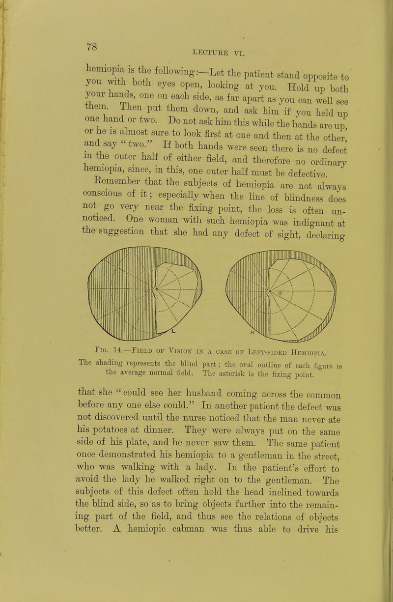 LECTURE VI. h mxop a IS the followmg :-Let the patient stand opposite to you with both eyes open, looking at you. Hold up both your hands, one on each side, as far apart as you can well see them. Then put them down, and ask him if you held up one hand or two. Do not ask him this while the hands are up or he IS almost sure to look first at one and then at the other' and say  two. If both hands were seen there is no defect m the outer half of either field, and therefore no ordinary hemiopia, since, in this, one outer half must be defective Eemember that the subjects of hemiopia are not always conscious of it; especiaUy when the Hne of bhndness does not_ go very near the fixing point, the loss is often un- noticed. One woman with such hemiopia was indignant at the suggestion that she had any defect of sight, declaring Fig. 14.—Field of Vision in a case of Left-sided Hemiopia. The shading represents the blind part: the oval outline of each figure is the average uormal field. The asterisk is the fixing point. that she  could see her husband coming across the common before any one else could. In another patient the defect was not discovered until the nurse noticed that the man never ate his potatoes at dinner. They were always put on the same side of his plate, and he never saw them. The same patient once demonstrated his hemiopia to a gentleman in the street, who was walking with a lady. In the patient's effort to avoid the lady he walked right on to the gentleman. The subjects of this defect often hold the head inclined towards the blind side, so as to bring objects fm-ther into the remain- ing part of the field, and thus see the relations of objects better. A liemioj)io cabman was thus able to drive his