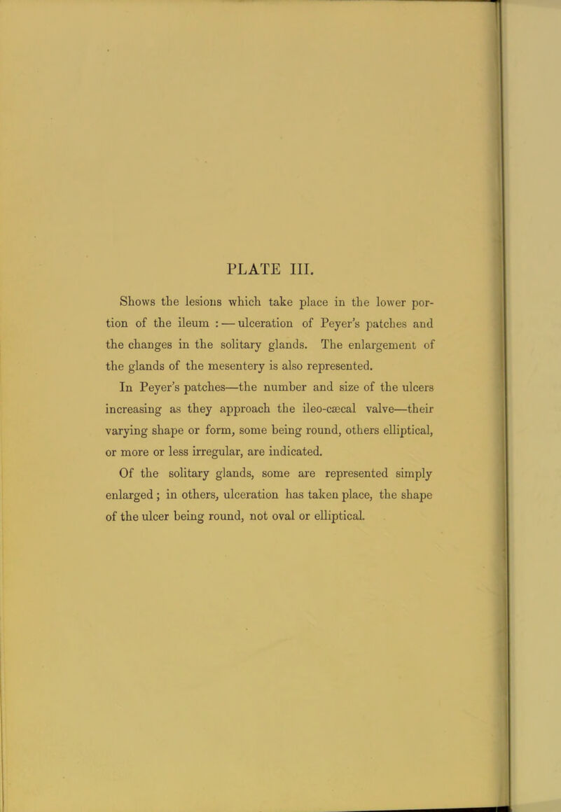 Shows the lesions which take place in the lower por- tion of the ileum : — ulceration of Peyer's patches and the changes in the solitary glands. The enlargement of the glands of the mesentery is also represented. In Peyer's patches—the number and size of the ulcers increasing as they approach the ileo-csecal valve—their varying shape or form, some being round, others elliptical, or more or less irregular, are indicated. Of the solitary glands, some are represented simply enlarged ; in others, ulceration has taken place, the shape of the ulcer being round, not oval or elliptical
