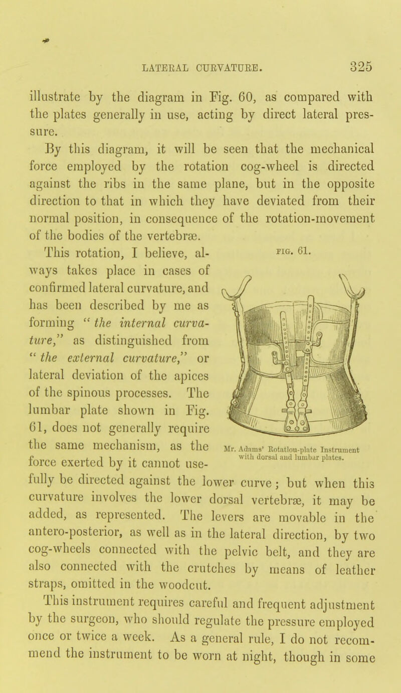 FIG. 61. illustrate by the diagram in Fig. 60, as compared with the plates generally in use, acting by direct lateral pres- sure. By this diagram, it will be seen that the mechanical force employed by the rotation cog-wheel is directed against the ribs in the same plane, but in the opposite direction to that in which they have deviated from their normal position, in consequence of the rotation-movement of the bodies of the vertebrae. This rotation, I believe, al- ways takes place in cases of confirmed lateral curvature, and has been described by me as forming  the internal curva- ture, as distinguished from  the external curvature, or lateral deviation of the apices of the spinous processes. The lumbar plate shown in Fig. 61, does not generally require the same mechanism, as the force exerted by it caimot use- fully be directed against the lower curve; but when this curvature involves the lower dorsal vertebra, it may be added, as represented. The levers are movable in the antero-posterior, as well as in the lateral direction, by two cog-wheels connected with the pelvic belt, and they are also connected with the crutches by means of leather straps, omitted in the woodcut. This instrument requires careful and frequent adjustment by the surgeon, who should regulate the pressure employed once or twice a week. As a general rule, I do not recom- mend the instrument to be worn at night, though in some Mr. Adams' Rotatlou-plate Instrument with (lorscU aud lumbar plates.