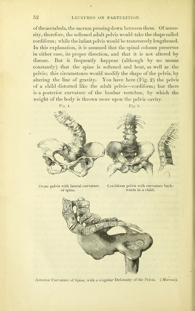 of the acetab ula, the sacrum pressingdown between them. Of neces- sity, therefore, the softened adult pelvis would take the shape called cordiform; while the infant pelvis would be transversely lengthened. In this explanation, it is assumed that the spinal column preserves in either case, its proper direction, and that it is not altered by disease. But it frequently happens (although by no means constantly) that the spine is softened and bent, as well as the pelvis; this circumstance would modify the shape of the pelvis, by altering the line of gravity. You have here (Fig. 2) the pelvis of a child distorted like the adult pelvis—cordiform; but there is a posterior curvature of the lumbar vertebras, by which the weight of the body is thrown more upon the pelvic cavity. Fig. 1. Fig. 2. Anterior Curvature of Spine, with a singular Deformity of the Pelvis. (Moreau). Ovate pelvis with lateral curvature of spine. Cordiform pelvis with curvature back- wards in a child.
