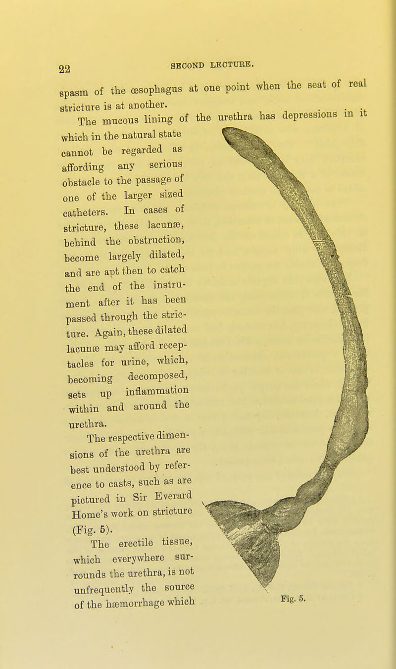 spasm of the oesophagus at one point when the seat of real stricture is at another. _ . The mucous lining of the urethra has depressions m it which in the natural state cannot be regarded as affording any serious obstacle to the passage of one of the larger sized catheters. In cases of stricture, these lacuna?, behind the obstruction, become largely dilated, and are apt then to catch the end of the instru- ment after it has been passed through the stric- ture. Again, these dilated lacunae may afford recep- tacles for urine, which, becoming decomposed, sets up inflammation within and around the urethra. The respective dimen- sions of the urethra are best understood by refer- ence to casts, such as are pictured in Sir Everard Home's work on stricture (Fig. 5). The erectile tissue, which everywhere sur- rounds the urethra, is not unfrequently the source of the haemorrhage which Fig. 5.