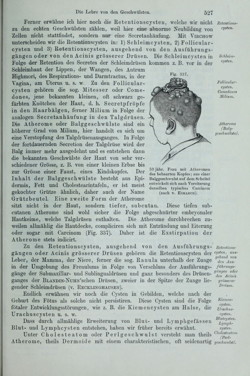 Fig. 337. Ferner erwähne ich hier noch die Retentionscysten, welche wir nicht zu den echten Geschwülsten zählen, weil hier eine abnorme Neubildung von Zellen nicht stattfindet, sondern nur eine Secretanliäufung. Mit Virchow unterscheiden wir die Retentionscysten in: 1) Schleimcysten, 2) Follicular- cysten und 3) Retentionscysten, ausgehend von den Ausführungs- gängen oder von den Acinis grösserer Drüsen. Die Schleimcysten in Folge der Retention des Secretes der Schleimdrüsen kommen z. B. vor in der Schleimhaut der Lippen, der Wangen, des Antrum Highmori, des Respirations- und Darmtractus, in der Vagina, am Uterus u. s. w- Zu den Follicular- cysten gehören die sog. Mitesser oder Come- dones, jene bekannten kleinen, oft schwarz ge- färbten Knötchen der Haut, d. h. Secretpfröpfe in den Haarbälgen, ferner Milium in Folge der analogen Secretanhäufung in den Talgdrüsen. Die Atherome oder Balggeschwülste sind ein höherer Grad von Milium, hier handelt es sich um eine Verstopfung des Talgdrüsenausganges. In Folge der fortdauernden Secretion der Talgdrüse wird der Balg immer mehr ausgedehnt und es entstehen dann die bekannten Geschwülste der Haut von sehr ver- schiedener Grösse, z. B. von einer kleinen Erbse bis zur Grösse einer Faust, eines Kindskopfes. Der Inhalt der Balggeschwülste besteht aus Epi- Eaiggesehrvuist auf dem Scheitel dermis, Fett und Cholestearintafeln, er ist meist *ntw,ckelt sieh.na^h' Reiterung gekochter Grütze ähnlich, daher auch der Name (nach v. Esmarch). Grützbeutel. Eine zweite Form der Atherome sitzt nicht in der Haut, sondern tiefer, subcutan. Diese tiefen sub- cutanen Atherome sind wohl sicher die Folge abgeschnürter embryonaler Hautkeime, welche Talgdrüsen enthalten. Die Atherome durchbrechen zu- weilen allmählig die Hautdecke, compliciren sich mit Entzündung und Eiterung oder sogar mit Carcinom (Fig. 337). Daher ist die Exstirpation der Atherome stets indicirt. Zu den Retentionscysten, ausgehend von den Ausführungs- gängen oder Acinis grösserer Drüsen gehören die Retentionscysten der Leber, der Mamma, der Niere, ferner die sog. Ranula unterhalb der Zunge in der Umgebung des Frenulums in Folge von Verschluss der Ausführungs- gänge der Submaxillar- und Sublingualdrüsen und ganz besonders des Drüsen- ganges der BLANDiN-NüHN’schen Drüsen, zweier in der Spitze der Zunge lie- gender Schleimdrüsen (v. Recklinghausen). Endlich erwähnen wir noch die Cysten in Gebilden, welche nach der Geburt des Fötus als solche nicht persistiren. Diese Cysten sind die Folge fötaler Entwicklungsstörungen, wie z. B. die Kiemencysten am Halse, die Urachuscysten u. s. w. Dass durch allmälilige Erweiterung von Blut- und Lymphgefässen Blut- und Lymphcysten entstehen, haben wir früher bereits erwähnt. Unter Cholesteatom oder Perlgeschwulst versteht man theils Atherome, theils Dermoide mit einem charakteristischen, oft seidenartig 59jähr. Frau mit Atheromen des behaarten Kopfes; aus einer Retentions- cysten. Schleim- cysten. Follicidar- cysten. Comedones Milium. Atherome (Balg- gesell uiühte). Retentions- cysten, aus- gehend von den Aus- führungs- gängen oder den Acinis grösserer Drüsen. Kiemen- cysten. Urachus- cysten. Blutcysten. Lymph- cysten. Cholesteatom (Perl- geschwulst).