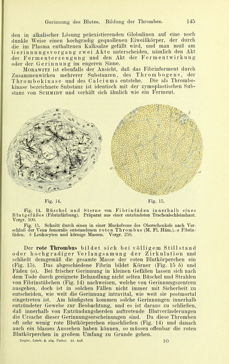 den in alkalischer Lösung präexistierenden Globulinen auf eine noch dunkle Weise einen hochgradig gequollenen Eiweißkörper, der durch die im Plasma enthaltenen Kalksalze gefällt wird, und man muß am Gerinnungsvorgang zwei Akte unterscheiden, nämlich den Akt der Fermenterzeugung und den Akt der Fermentwirkung oder der Gerinnung im engeren Sinne. MoRAwiTZ ist ebenfalls der Ansicht, daß das Fibrinferment durch Zusammenwirken mehrerer Substanzen, des T h r o m b o g e n s , der Thrombokinase und des Calciums entstehe. Die als Thrombo- kinase bezeichnete Substanz ist identisch mit der zymoplastischen Sub- stanz von Schmidt und verhält sich ähnlich wie ein Ferment. Fig. 14. Fig. 15. Fig. 14. Büschel und Sterne von Fibrinfäden innerhalb eines Blutgefäßes (Fibrinfärbung). Präparat aus einer entzündeten Tracheaischleimhaut. Vergr. 500. Fig. 15. Schnitt durch einen in einer Muskelvene des Oberschenkels nach Ver- schluß der Vena femoralis entstandenen roten Thrombus (M. Fl. Häm.)..a Fibrin- fäden, h Leukocyten und körnige Massen. Vergr. 250. Der rote Thrombus bildet sich bei völligem Stillstand oder hochgradiger Verlangsamung der Zirkulation und schließt demgemäß die gesamte Masse der roten Blutkörperchen ein (Fig. 15). Das abgeschiedene Fibrin bildet Körner (Fig. 15 b) und Fäden («). Bei frischer Gerinnung in kleinen Gefäßen lassen sich nach dem Tode durch geeignete Behandlung nicht selten Büschel und Strahlen von Fibrinstäbchen (Fig. 14) nachweisen, welche von Gerinnungszentren ausgehen, doch ist in solchen Fällen nicht immer mit Sicherheit zu entscheiden, wie weit die Gerinnung intravital, wie weit sie postmortal eingetreten ist. Am häufigsten kommen solche Gerinnungen innerhalb entzündeter Gewebe zur Beobachtung, und es ist daraus zu schließen, daß innerhalb von Entzündungsherden auftretende Blutveränderungen die Ursache dieser Gerinnungserscheinungen sind. Da diese Thromben oft sehr wenig rote Blutkörperchen einschließen (Fig. 14) und danach auch ein blasses Aussehen haben können, so müssen offenbar die roten Blutkörperchen in großem Umfang zu Grunde gehen. Ziegler, Lehrb. d. allg. Pathol. 11. Aufl. 10