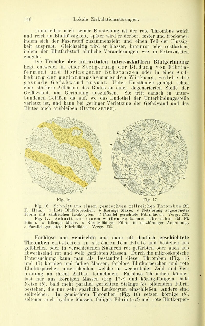 Unmittelbar nach seiner Entstehung ist der rote Thrombus weich und reich an Blutflüssigkeit, später wird er derber, fester und trockener, indem sich der Faserstoff zusammenzieht und einen Teil der Flüssig- keit auspreßt. Gleichzeitig wird er blasser, braunrot oder rostfarben, indem der Blutfarbstoff ähnliche Veränderungen wie in Extravasaten eingeht. Die IJrsaelie der iiitraTitalen intraYaskiilären Bliitgeriiiiiuiig' liegt entweder in einer Steigerung der Bildung von Fibrin- ferment und fibrinogener Substanzen oder in einer Auf- hebung der gerinnungshemmenden Wirkung, welche die gesunde Gefäßwand ausübt. Unter Umständen genügt schon eine stärkere Adhäsion des Blutes an einer degenerierten Stelle der Gefäßwand, um Gerinnung auszulösen. Sie tritt danach in unter- bundenen Gefäßen da auf, wo das Endothel der Unterbindungsstelle verletzt ist, und kann bei geringer Verletzung der Gefäßwand und des Blutes auch ausbleiben (Baumgarten). Fig. 16. Fig. 17. Fig. 16. Schnitt aus einem gemischten zellreichen Thrombus (M. Fl. Häm.). a Rote Blutkörperchen, b Körnige Masse, c Netzförmig angeordnetes Fibrin mit zahlreichen Leukocyten. d Parallel gerichtete Fibrinfäden. Yergr. 200. Fig. 17. Schnitt aus einem weißen zellarmen Thrombus (M. Fl. Häm.). a Körnige Masse, b Körnig-fädiges Fibrin in netzförmiger Anordnung, c Parallel gerichtete Fibrinfäden. Vergr. 200. Farblose und gemischte und dann oft deutlich gesehielitete Tliroml)eii entstehen in strömendem Blute und bestehen aus gelblichen oder in verschiedenen Nuancen rot gefärbten oder auch aus abwechselnd rot und weiß gefärbten Massen. Durch die mikroskopische Untersuchung kann man als Bestandteil dieser Thromben (Fig. It) und 17) körnige und fädige Massen, farblose Blutkörperchen und rote Blutkörperchen unterscheiden, welche in wechselnder Zahl und Ver- breitung an ihrem Aufbau teilnehmen. Farblose Thromben können fast nur aus körnigen Massen (Fig. IIa) und körnig-fädigem, bald Netze (ö), bald mehr parallel gerichtete Stränge (e) bildendem Fibrin bestehen, die nur sehr spärliche Leukocyten einschließen. Andere sind zellreicher. In gemischten Thromben (Fig. 16) setzen körnige {b), seltener auch hyaline Massen, fädiges Fibrin (c d) und rote Blutkörper-