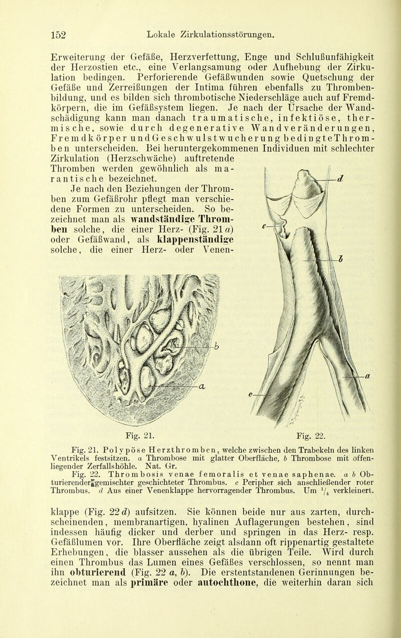 Erweiterung der Gefäße, Herzverfettung, Enge und Schlußunfähigkeit der Herzostien etc., eine Verlangsamung oder Aufhebung der Zirku- lation bedingen. Perforierende Gefäßwunden sowie Quetschung der Gefäße und Zerreißungen der Intima führen ebenfalls zu Thromben- bildung, und es bilden sich thrombotische Niederschläge auch auf Fremd- körpern, die im Gefäßsystem liegen. Je nach der Ursache der Waud- schädigung kann man danach traumatische, infektiöse, ther- mische, sowie durch degenerative Wand Veränderungen, FremdkörperundGeschwulstwucherungbedingteThrom- b e n unterscheiden. Bei heruntergekommenen Individuen mit schlechter Zirkulation (Herzschwäche) auftretende Thromben werden gewöhnlich als ma- rantische bezeichnet. Je nach den Beziehungen der Throm- ben zum Gefäßrohr pflegt man verschie- dene Formen zu unterscheiden. So be- zeichnet man als wantlstäiidige Throm- Ibeu solche, die einer Herz- (Fig. 21 a) oder Gefäßwand, als klappenstäiidige Fig. 21. Polypöse Herzthromben, welche zwischen den Trabekeln des linken Ventrikels festsitzen, a Thrombose mit glatter Oberfläche, b Thrombose mit offen- liegender Zerfalls höhle. Nat. Gr. Fig. 22. Thrombosis venae femoralis et venae saphenae. a b Ob- turierenderg'gemischter geschichteter Thrombus, c Peripher sich anschließender roter Thrombus, d Aus einer Venenklappe hervorragender Thrombus. Um verkleinert. klappe (Fig. 22 d) aufsitzen. Sie können beide nur aus zarten, durch- scheinenden , membranartigen, hyalinen Auflagerungen bestehen, sind indessen häufig dicker und derber und springen in das Herz- resp. Gefäßlumen vor. Ihre Oberfläche zeigt alsdann oft rippenartig gestaltete Erhebungen, die blasser aussehen als die übrigen Teile. Wird durch einen Thrombus das Lumen eines Gefäßes verschlossen, so nennt man ihn obturierend (Fig. 22 a, b). Die erstentstandenen Gerinnungen be- zeichnet man als primäre oder aiitoclithone, die weiterhin daran sich Fig. 21. Fig. 22.