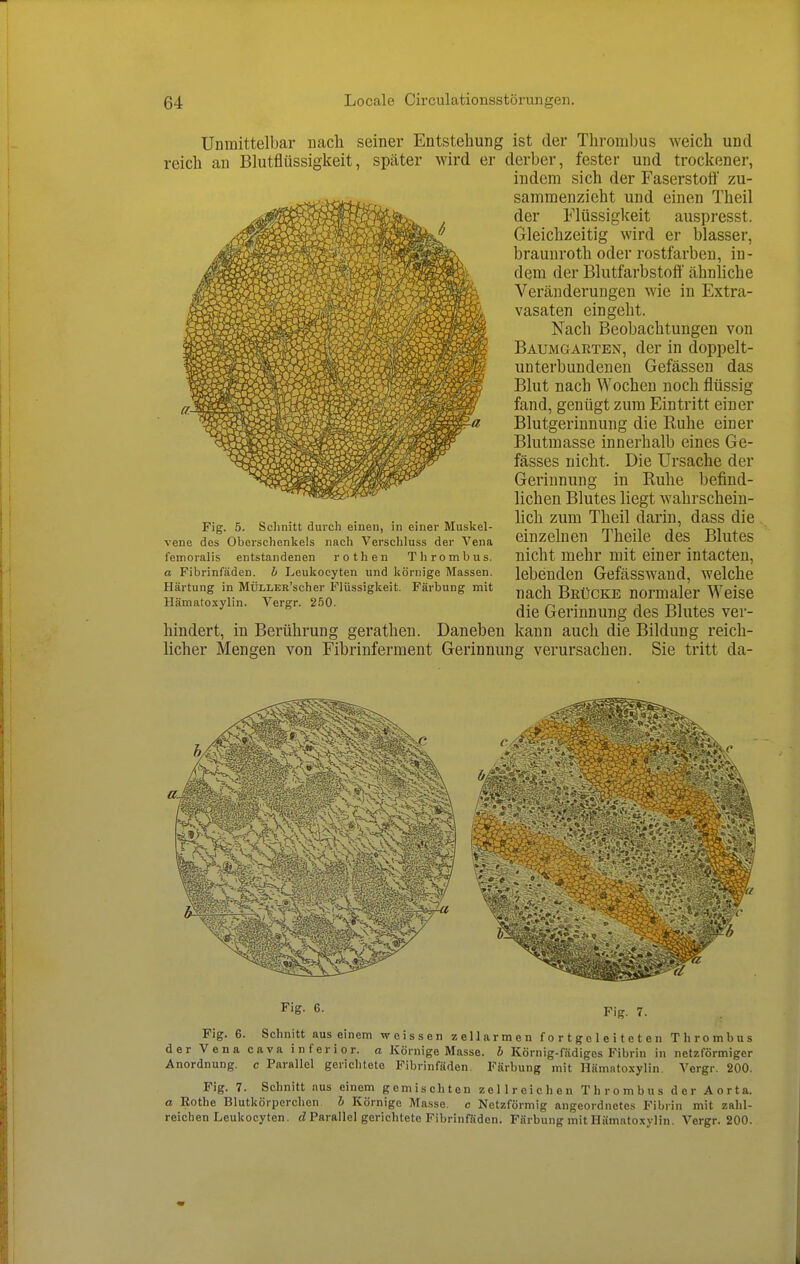 Unmittelbar nach seiner Entstehung ist der Thrombus reich an Blutflüssigkeit, später wird er derber, fester und Fig. 5. Schnitt durcli einen, in einer Muskel- vene des Oberschenkels nach Verschluss der Vena femoralis entstandenen rothen Thrombus. a Fibrinfäden, h Leukocyten und körnige Massen. Härtung in MÜLLER'scher Flüssigkeit. Färbung mit Hämatoxylin. Vergr. 250. hindert, lieber in Berührung Mengen gerathen. Daneben von Fibrinferment Gerinnung weich und trockener, indem sich der Faserstoff zu- sammenzieht und einen Theil der Flüssigkeit auspresst. Gleichzeitig wird er blasser, brauiiroth oder rostfarben, in- dem der Blutfarbstoff ähnliche Veränderungen wie in Extra- vasaten eingeht. Nach Beobachtungen von Baumgarten, der in doppelt- unterbundenen Gefässen das Blut nach Wochen noch flüssig fand, genügt zum Eintritt einer Blutgerinnung die Ruhe einer Blutmasse innerhalb eines Ge- fässes nicht. Die Ursache der Gerinnung in Ruhe befind- lichen Blutes liegt wahrschein- lich zum Theil darin, dass die einzelnen Theile des Blutes nicht mehr mit einer intacten, lebenden Gefässwand, welche nach Brücke normaler Weise die Gerinnung des Blutes ver- kann auch die Bildung reich- verursachen. Sie tritt da- Fig. 6. Fig. 7. Fig. 6. Schnitt aus einem weissen zellarmen fortgcleiteten Thrombus der Vena cava inferior, a Körnige Masse, h Körnig-fädiges Fibrin in netzförmiger Anordnung, c Parallel gerichtete Fibrinfäden. Färbung mit Hämatoxylin. Vergr. 200. Fig. 7. Schnitt aus einem gemischten zellreicheu Thrombus der Aorta. a Rothe Blutkörperchen h Körnige Masse, c Netzförmig angeordnetes Fibrin mit zahl- reichen Leukocyten. Parallel gerichtete Fibrinfäden. Färbung mit Hämatoxylin. Vergr. 200.