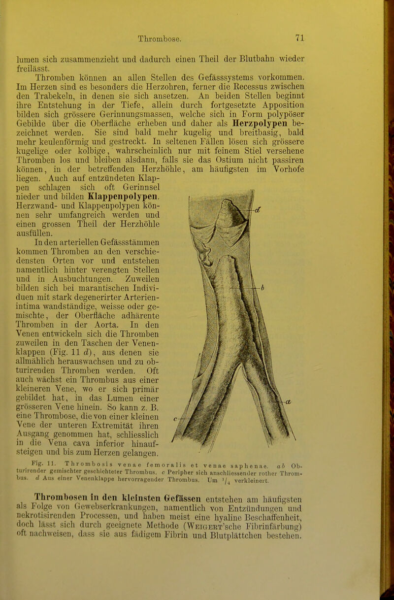 lumeu sich zusammenzieht und dadurch einen Theil der Blutbahu wieder freilässt. Thromben können an allen Stellen des Gefässsystems vorkommen. Im Herzen sind es besonders die Herzohren, ferner die Recessus zwischen den Trabekeln, in denen sie sich ansetzen. An beiden Stellen beginnt ihre Entstehung in der Tiefe, allein durch fortgesetzte Apposition bilden sich grössere Gerinnungsmassen, welche sich in Form polypöser Gebilde über die Oberfläche erheben und daher als Herzpolypen be- zeichnet werden. Sie sind bald mehr kugelig und breitbasig, bald mehr keulenförmig und gestreckt. In seltenen Fällen lösen sich grössere kugelige oder kolbige, wahrscheinlich nur mit feinem Stiel versehene Thromben los und bleiben alsdann, falls sie das Ostium nicht passiren können, in der betreifenden Herzhöhle, am häufigsten im Vorhofe liegen. Auch auf entzündeten Klap- pen schlagen sich oft Gerinnsel nieder und bilden Klappenpolypen. Herzwand- und Klappenpolypen kön- nen sehr umfangreich werden und einen grossen Theil der Herzhöhle ausfüllen. In den arteriellen Gefässstämmen kommen Thromben an den verschie- densten Orten vor und entstehen namentlich hinter verengten Stellen und in Ausbuchtungen. Zuweilen bilden sich bei marantischen Indivi- duen mit stark degenerirter Arterien- intima wandständige, weisse oder ge- mischte, der Oberfläche adhärente Thromben in der Aorta. In den Venen entwickeln sich die Thromben zuweilen in den Taschen der Venen- klappen (Fig. 11 d), aus denen sie allmählich herauswachsen und zu ob- turirenden Thromben werden. Oft auch wächst ein Thrombus aus einer kleineren Vene, wo er sich primär gebildet hat, in das Lumen einer grösseren Vene hinein. So kann z. B. eine Thrombose, die von einer kleinen Vene der unteren Extremität ihren Ausgang genommen hat, schliesslich in die Vena cava inferior hinauf- steigen und bis zum Herzen gelangen. Fig. 11. Thrombosis venac femoralis et venne saphenae. ab Ob- turirender gemischter geschichteter Thrombus, c Peripher sich anschliessender rother Throm- bus. d Aus einer Venenkiappe hervorragender Thrombus. Um '/^ verldeinert. Thrombosen in den kleinsten G^efässen entstehen am häufigsten als Folge von Gewebserkrankungen, namentlich von Entzündun^•eu und nekroti.sirenden Processen, und haben meist eine hyaline Beschaffenheit, doch lässt sich durch geeignete Methode (WEioERT'sche Fibrinfärbung) oft nachweisen, dass sie aus fädigem Fibrin und Blutplättchen bestehen.