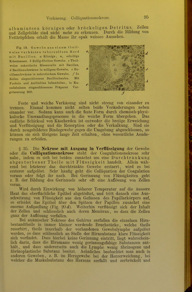 Verkäsung. CoUiquationsnekrose. albumiüösen körnigen oder bröckeligen Detritus. Zellen imd Zellgebilde sind nicht mehr zu erkennen. Durch die Bildung von Fetttröpfchen erhält die Masse ihr opak weisses Aussehen. Fig. 19. Gewebe aus einem tlieil- weise verkSsten tuberculösen Herd mit Bacillen, a Körnige, o, schollige Käsemassen, b ZeUig-fibröses Gewebe, c Theil- weise nekrotische Riesenzelle mit Bacillen. d Bacillenschwärme in zelligem Gewebe, e Ba- cillenschwärme in nekrotischem Gewebe. / In Zellen eingeschlossene Bacillenhaufen. Mit Fuchsin und Anilinblau behandeltes, in Ka- nadabalsam eingeschlossenes Präparat. Ver- grösserung 200. Feste und weiche Verkäsung sind nicht streng von einander zu trennen. Einmal kommen nicht selten beide Veränderungen neben einander vor. Sodann kann auch die feste Form durch chemisch-physi- kalische Umwandlungsprocesse in die weiche Form übergehen. Das endliche Schicksal von Käseherden ist entweder die breiige Erweichung und Verflüssigung und die Resorption oder die Verkalkung. Sind sie durch neugebildetes Bindegewebe gegen die Umgebung abgeschlossen, so können sie sich übrigens lange Zeit erhalten, ohne wesentliche Aende- rungen zu erleiden. § 35. Die Nekrose mit Ausgang in Verflüssigung der Gewebe oder die CoUiquationsnekrose steht der Coagulationsnekrose sehr nahe, indem es sich bei beiden zunächst um eine Durchtränkung abgestorbener Theile mit Flüssigkeit handelt. Allein wäh- rend bei letzterer das durchtränkte Gewebe erstarrt, wird es bei ersterer aufgelöst. Sehr häufig geht die Colliquation der Coagulation voraus oder folgt ihr nach. Bei Gerinnung von Flüssigkeiten geht z. B. der Bildung des Gerinnsels sehr oft eine Auflösung von Zellen voran. Wird durch Einwirkung von höherer Temperatur auf die äussere Haut das oberflächliche Epithel abgetödtet, und tritt danach eine Aus- schwitzung von Flüssigkeit aus den Gefässen des Papillarkörpers auf, so erleidet das Epithel über den Spitzen der Papillen zunächst eine enorme Aufquellung (Fig. 20 d). Weiterhin verflüssigt sich der Inhalt der Zellen und schhesslich auch deren Membran, so dass die Zellen ganz der Auflösung verfallen. Bei anämischer Nekrose des Gehirns zerfallen die einzelnen Hirn- bestandtheile in immer kleiner werdende Bruchstücke, welche theils resorbirt, theils innerhalb der vorhandenen Gewebslymphe aufgelöst werden, so dass schliesslich an Stelle der Hirnsubstanz klare Flüssigkeit sich vorfindet. Dass hierbei keine Gerinnung eintritt, liegt wahrschein- lich darin, dass die Himraasse wenig gerinnungsfähige Substanzen ent- hält, und dass andererseits auch die Lymphe wenig fibriuogene imd fibrinoplastische Substanz besitzt. Aehnliches beobachtet man auch in anderen Geweben, z. B. im Herzgewebe bei der Herzerweichung, bei welcher die Muskelsubstanz des Herzens zerfällt und zerbröckelt und