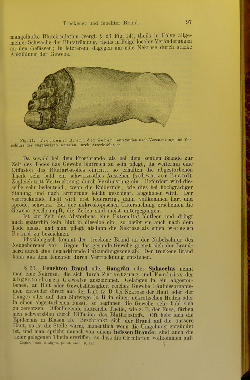 mangelhafte Bliitcirculation (vergl. § 23 Fig. 14), theils in Folge allge- meiner Schwäche der Blutströmung, theils in Folge localer Veränderungen an den Gefässen; in letzterem dagegen um eine Nekrose durch starke Abkühlung der Gewebe. Fig. 21. Trockener Brand der Zehen, entstanden nach Verengerung und Ver- schluss der zugehörigen Arterien durch Arteriosclerose. Da sowohl bei dem Frostbrande als bei dem senilen Brande zur Zeit des Todes das Gewebe blutreich zu sein pflegt, da weiterhin eine Diffusion des Blutfarbstoffes eintritt, so erhalten die abgestorbenen Theile sehr bald ein schwarzrothes Aussehen (schwarzer Brand). Zugleich tritt Vertrocknung durch Verdunstung ein. Befördert wird die- selbe sehr bedeutend, wenn die Epidermis, wie dies bei hochgradiger Stauung und nach Erfrierung leicht geschieht, abgehoben wird. Der vertrocknende Theil wird erst lederartig, dann vollkommen hart und spröde, schwarz. Bei der mikroskopischen Untersuchung erscheinen die Gewebe geschrumpft, die Zellen sind meist untergegangen. Ist zur Zeit des Absterbens eine Extremität blutleer und dringt auch späterhin kein Blut in dieselbe ein, so bleibt sie auch nach dem Tode blass, und man pflegt alsdann die Nekrose als einen weissen Brand zu bezeichnen. Physiologisch kommt der trockene Brand an der Nabelschnur des Neugeborenen vor. Gegen das gesunde Gewebe grenzt sich der Brand- herd durch eine deraarkirende Entzündungszone ab. Der trockene Brand kann aus dem feuchten durch Vertrocknung entstehen. § 37. Feuchten Brand oder (xangrän oder Sphacelus nennt man eine Nekrose, die sich durch Zersetzung und Fäulniss der abgestorbenen Gewebe auszeichnet. Gelangen in ein abgestor- benes, an Blut oder Gewebsflüssigkeit reiches Gewebe Fäulnissorganis- men entweder direct aus der Luft (z. B. bei Nekrose der Haut oder der Lunge) oder auf dem Blutwege (z. B. in einen nekrotischen Hoden oder in einen abgestorbenen Fuss), so beginnen die Gewebe sehr bald sich zu zersetzen. Ofienliegende blutreiche Theile, wie z. B. der Fuss, färben sich schwarzblau durch Diftusion des Blutfarbstoffs. Oft hebt sich die Epidermis in Blasen ab. Beschränkt sich der Brand auf die äussere Haut, so ist die Stelle warm, namentlich wenn die Umgebung entzündet ist, und man spricht danach von einem heisscn Brande; sind auch die tiefer gelegenen Theile ergriffen, so dass die Circulation vollkommen auf- Zlegler, I.ehrb. d. allgom. pathol. Aniit. 6, Aull. 7