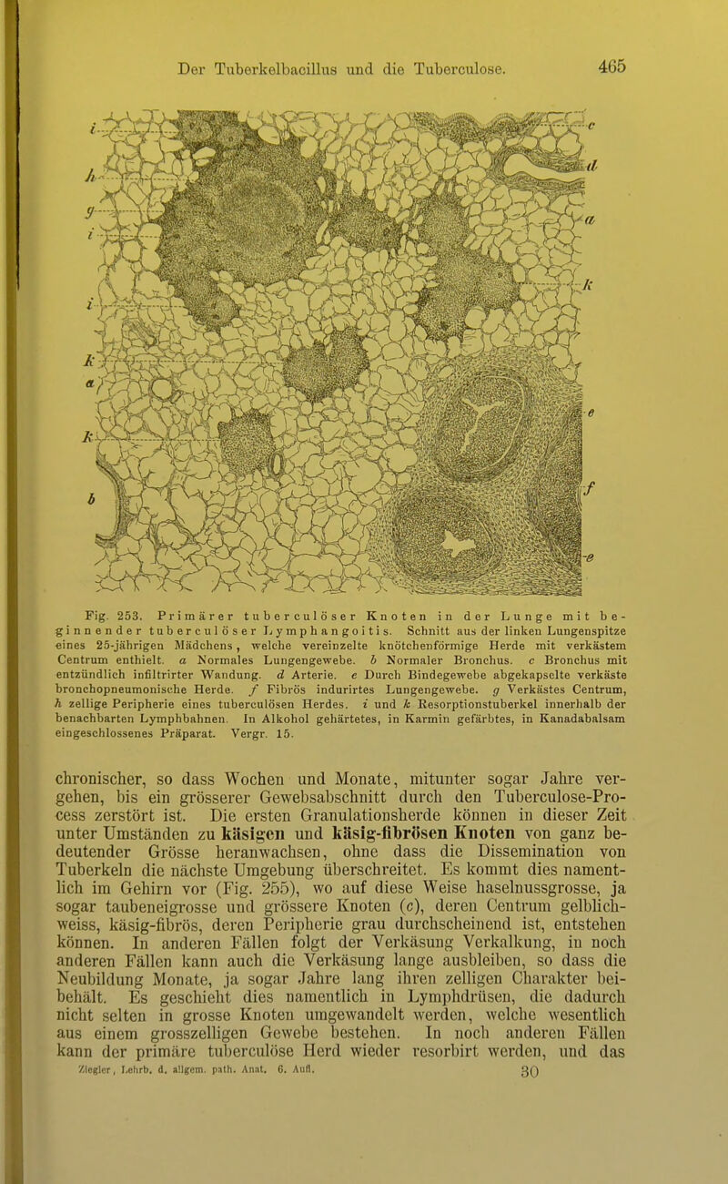 Fig. 253. Primärer tuberculöser Knoten in der Lunge mit be- ginnender tuberculöser Lymphangoitis. Schnitt aus der linken Lungenspitze eines 25-jährigen Mädchens, welche vereinzelte knötchenförmige Herde mit verkästem Centrum enthielt, a Mormales Lungengewebe, h Normaler Bronchus, c Bronchus mit entzündlich infiltrirter Wandung, d Arterie, e Durch Bindegewebe abgekapselte verkäste bronchopneumonische Herde, f Fibrös indurirtes Lungengewebe, g Verkästes Centrum, Ä zellige Peripherie eines tuberculösen Herdes, i und k Resorptionstuberkel innerhalb der benachbarten Lymphbahnen. In Alkohol gehärtetes, in Karmin gefärbtes, in Kanadabalsam eingeschlossenes Präparat. Vergr. 15. chronischer, so dass Wochen und Monate, mitunter sogar Jahre ver- gehen, bis ein grösserer Gewebsabschnitt durch den Tuberculose-Pro- cess zerstört ist. Die ersten Granulationsherde können in dieser Zeit unter Umständen zu käsigen und käsig-fibrösen Knoten von ganz be- deutender Grösse heranwachsen, ohne dass die Dissemination von Tuberkeln die nächste Umgebung überschreitet. Es kommt dies nament- lich im Gehirn vor (Fig. 255), wo auf diese Weise haselnussgrosse, ja sogar taubeneigrosse und grössere Knoten (c), deren Centrum gelblich- weiss, käsig-fibrös, deren Peripherie grau durchscheinend ist, entstehen können. In anderen Fällen folgt der Verkäsung Verkalkung, in noch anderen Fällen kann auch die Verkäsung lange ausbleiben, so dass die Neubildung Monate, ja sogar Jahre lang ihren zelligen Charakter bei- behält. Es geschieht dies namentlich in Lymphdrüsen, die dadurch nicht selten in grosse Knoten umgewandelt werden, welche wesentlich aus einem grosszelligen Gewebe bestehen. In noch anderen Fällen kann der primäre tuberculöse Herd wieder resorbirt werden, und das ziegler, I.ohrb. d. a'.lgem. p.Tth. Anat. G. Aufl. QQ