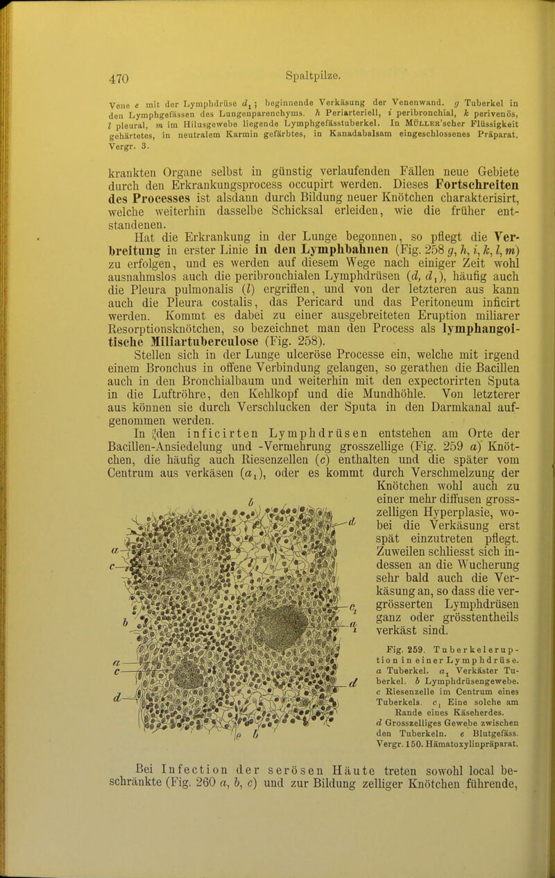 Vene e mit der Lymphdrüse ; beginnende Verkäsung der Venenwand, g Tuberkel in den Lymphgefässen des Lungenparenchyms, h Periarteriell, i peribronchial, k perivenös, l pleural, m, im Hilusgewebe liegende Lymphgefässtuberkel. In MüLLER'scher Flüssigkeit gehärtetes, in neutralem Karmin gefärbtes, in Kanadabalsam eingeschlossenes Präparat. Vergr. 3. krankten Organe selbst in günstig verlaufenden Fällen neue Gebiete durch den Erkrankungsprocess occupirt werden. Dieses Fortschreiten des Processes ist alsdann durch Bildung neuer Knötchen charakterisirt, welche weiterhin dasselbe Schicksal erleiden, wie die früher ent- standenen. Hat die Erkrankung in der Lunge begonnen, so pflegt die Ver- breitung in erster Linie in den Lymphlbahnen (Fig. 258 g, ä, i, ä, l, m) zu erfolgen, und es werden auf diesem Wege nach einiger Zeit wohl ausnahmslos auch die peribronchialen Lymphdrüsen (d, d^), häufig auch die Pleura pulmonalis (I) ergriffen, und von der letzteren aus kann auch die Pleura costalis, das Pericard und das Peritoneum inficirt werden. Kommt es dabei zu einer ausgebreiteten Eruption miliarer Resorptionsknötchen, so bezeichnet man den Process als lymphangoi- tische Miliartuberculose (Fig. 258). Stellen sich in der Lunge ulceröse Processe ein, welche mit irgend einem Bronchus in offene Verbindung gelangen, so gerathen die Bacillen auch in den Bronchialbaum und weiterhin mit den expectorirten Sputa in die Luftröhre, den Kehlkopf und die Mundhöhle. Von letzterer aus können sie durch Verschlucken der Sputa in den Darmkanal auf- genommen werden. In i'den inficirten Lymphdrüsen entstehen am Orte der Bacillen-Ansiedelung und -Vermehrung grosszelHge (Fig. 259 a) Knöt- chen, die häufig auch Riesenzellen (c) enthalten und die später vom Centrum aus verkäsen (aj, oder es kommt durch Verschmelzung der Knötchen wohl auch zu einer mehr diffusen gross- zelligen Hyperplasie, wo- bei die Verkäsung erst spät einzutreten pflegt. Zuweilen schliesst sich in- dessen an die Wucherung sehr bald auch die Ver- käsung an, so dass die ver- grösserten Lymphdrüsen ganz oder grösstentheils verkäst sind. Fig. 259. Tuberkelerup- tion in einer Lymphdrüse. a Tuberkel, Verkäster Tu- berkel, b Lymphdrüsengewebe, c Riesenzelle im Centrum eines Tuberkels, c, Eine solche am Rande eines Käseherdes. d Grosszelliges Gewebe zwischen den Tuberkeln. e Blutgefäss. Vergr. 150. Hämatoxylinpräparat. Bei Infection der serösen Häute treten sowohl local be- schränkte (Fig. 260 a, &, c) und zur Bildung zelliger Knötchen führende.