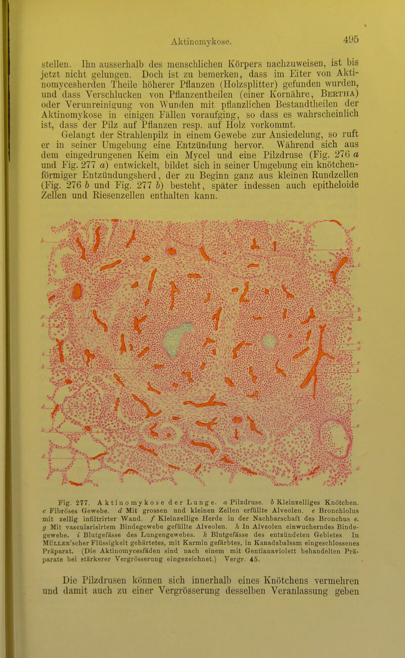 stclleii. Ihn ausserhalb des meiischlicheu Körpers nachzuweisen, ist bis jetzt nicht gehingeu. Doch ist zu bemerken, dass im Eiter von Akti- nomycesherden Theile höherer Pflanzen (HolzspUtter) gefunden wurden, und dass Verschhicken von Pflanzentheilen (einer Kornähre, Bertha) oder Verunreinigung von Wunden mit pflanzlichen Bestaudtheileu der Aktinomykose in einigen Fällen voraufging, so dass es wahrscheinlich ist, dass der Pilz auf Pflanzen resp. auf Holz vorkommt. Gelangt der Strahlenpilz in einem Gewebe zur Ansiedelung, so ruft er in seiner Umgebung eine Entzündung hervor. Während sich aus dem eingedrungenen Keim ein Mycel und eine Pilzdruse (Fig. 276 a und Fig. 277 a) entwickelt, bildet sich in seiner Umgebung ein knötchen- förmiger Entzündungsherd, der zu Beginn ganz aus kleinen Rundzellen (Fig. 276 b und Fig. 277 h) besteht, später indessen auch epitheloide Zellen und Riesenzellen enthalten kann. Fig. 277. Aktinomykose der Lunge, a Pilzdruse. 5 RleinzeUiges Knötchen, c Fibröses Gewebe, d Mit grossen und kleinen Zellen erfüllte Alveolen, e Bronchiolus mit zellig infiltrirter Wand. / Kleinzellige Herde in der Nachbarschaft des Bronchus e. g Mit vascularisirtem Bindegewebe gefüllte Alveolen, h In Alveolen einwucherndes Binde- gewebe, i Blutgefässe des Lungengewebes, h Blutgefässe des entzündeten Gebietes. In MüLLER'scher Flüssigkeit gehärtetes, mit Karmin gefärbtes, in Kanadabalsam eingeschlossenes Präparat. (Die Aktinomycesfäden sind nach einem mit Gentianaviolett behandelten Prä- parate bei stärkerer Vergrösserung eingezeichnet.) Vergr. 45. Die Pilzdrusen können sich innerhalb eines Knötchens vermehren und damit auch zu einer Vergrösserung desselben Veranlassung geben