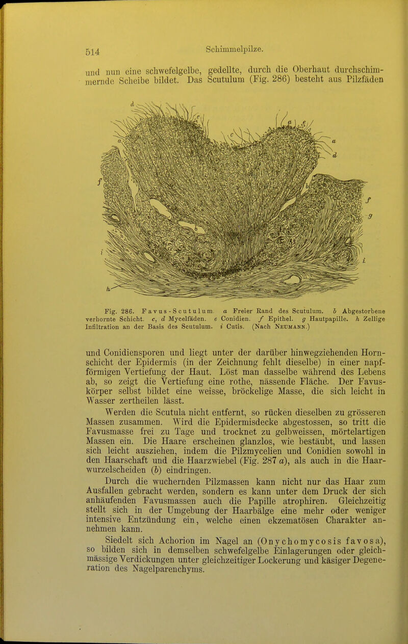 und uun eine schwefelgelbe, gedellte, durch die Oberhaut durchschim- mernde Sclieibe bildet. Das Scutulum (Fig. 286) besteht aus Pilzfäden Fig. 286. Favus-Scutulum. a Freier Rand des Scutulura. 5 Abgestorbene verbornte Schicht, c, d Mycelfäden. e Conidien. / Epithel, g HautpapiUe. h Zellige Infiltration an der Basis des Scutulum. i Cutis. (Nach Nedmann.) und Conidiensporen und liegt unter der darüber hinwegziehenden Horn- schicht der Epidermis (in der Zeichnung fehlt dieselbe) in einer napf- förmigen Vertiefung der Haut. Löst man dasselbe während des Lebens ab, so zeigt die Vertiefung eine rothe, nässende Fläche. Der Favus- körper selbst bildet eine weisse, bröckelige Masse, die sich leicht in Wasser zertheilen lässt. Werden die Scutula nicht entfernt, so rücken dieselben zu grösseren Massen zusammen. Wird die Epidermisdecke abgestossen, so tritt die Favusmasse frei zu Tage und trocknet zu gelbweissen, mörtelartigen Massen ein. Die Haare erscheinen glanzlos, wie bestäubt, und lassen sich leicht ausziehen, indem die Pilzmycelien und Conidien sowohl in den Haarschaft und die Haarzwiebel (Fig. 287 a), als auch in die Haar- wurzelscheiden (&) eindringen. Durch die wuchernden Pilzmassen kann nicht nur das Haar zum Ausfallen gebracht werden, sondern es kann unter dem Druck der sich anhäufenden Favusmassen auch die Papille atrophiren. Gleichzeitig stellt sich in der Umgebung der Haarbälge eine mehr oder weniger intensive Entzündung ein, welche einen ekzematösen Charakter an- nehmen kann. Siedelt sich Achorion im Nagel an (Onychomycosis favosa), so bilden sich in demselben schwefelgelbe Einlagerungen oder gleich- massige Verdickungen unter gleichzeitiger Lockerung und käsiger Degene- ration des Nagelparenchyms.