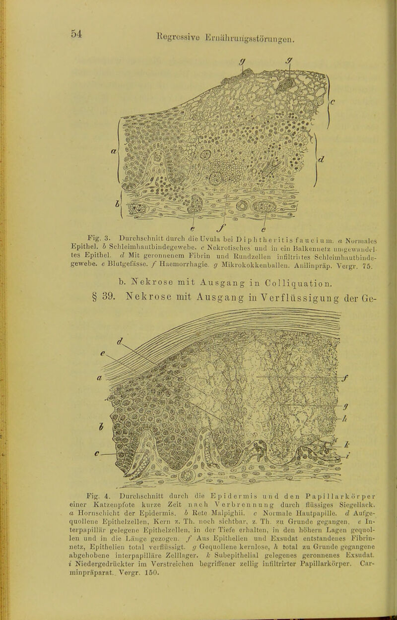 Fig. 3. Durchschnitt durch die Uvula bei Dipl] t her itis fauciu in. «Normales Epithel, b Schleimhautbhidegewebe. <■ Nekrotisches und in ein Balkennetz umgewandel- tes Epithel, d Mit geronnenem Fibrin und Rundzellen infiltriites Schleimhautbindc- gewebe. e Blutgefässe. / Huemorrliagie. g Mikrokokkenballen. Anilinpräp. Vcrgr. 75. b. Nekrose mit Ausgang in Co 1 liquation. § 39. Nekrose mit Ausgang in Verflüssigung der Ge- Fig. 4. Durchschnitt durch die Epidermis und den Papillarkö'rper einer Katzenpfote kurze Zeit nnch Verbrennung durch flüssiges Siegellack. a Hornschicht der Epidermis, h liutc Malpighii. <• Normale Hautpapille. d Aufge- quollene Epithelzellen, Kern •/,. Th. noch sichtbar, /.. Th. zu Grunde gegangen, t lu- terpapillftr gelegene Epithelzellen, in der Tiefe erhalten, in den höhern Lagen gequol- len und in die Länge gezogen, f Aus Epithelien und Exsudat entstandenes Fibrin- netz, Epithelicn totiil verflüssigt. ,</ Gequollene kernlose, h total zu Grunde gegangene abgehobene interpapilläre Zellinger. /.: Subepithclial gelegenes geronnenes Lxsudat. i Niedergedrückter im Verstreichen begriflener zeitig inliltrirtcr Papillarkörper. Car- minpräparat. Vergr. 150.