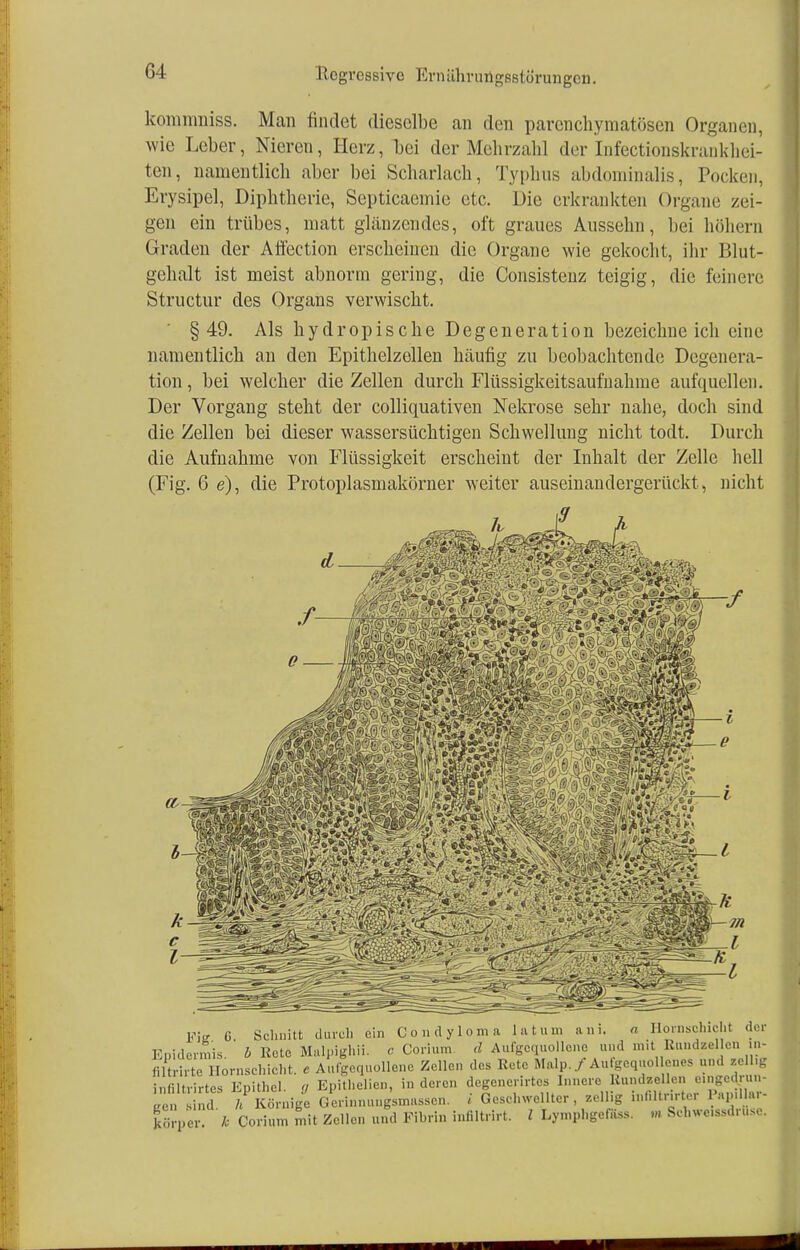 kommniss. Man findet dieselbe an den parenchymatösen Organen, wie Leber, Nieren, Herz, bei der Mehrzahl der Infectionskninkhei- ten, namentlich aber bei Scharlach, Typhus abdominalis, Pocken, Erysipel, Diphtherie, Septicacmie etc. Die erkrankten Organe zei- gen ein trübes, matt glänzendes, oft graues Aussehn, bei höhern Graden der Affection erscheinen die Organe wie gekocht, ihr Blut- gehalt ist meist abnorm gering, die Consistenz teigig, die feinere Structur des Organs verwischt. §49. Als hydropische Degeneration bezeichne ich eine namentlich an den Epithelzellen häufig zu beobachtende Degenera- tion , bei welcher die Zellen durch Flüssigkeitsaufnahme aufquellen. Der Vorgang steht der colliquativen Nekrose sehr nahe, doch sind die Zellen bei dieser wassersüchtigen Schwellung nicht todt. Durch die Aufnahme von Flüssigkeit erscheint der Inhalt der Zelle hell (Fig. 6 e), die Protoplasmakörner weiter auseinandergerückt , nicht 9 Fitr ß Schnitt durch ein Condyloma latum ani. a Hornschicht der Enidermis ö Rete Malpighii. e Corium d Aufgequollene und mit Rundzellen in- filtrirte Hornschicht, e Aufgequollene Zellen des Retc Malp./Aufgequollenes und zcll.g infiltrirtes Epithel, g Epithelien, in deren degenerirtes Innere Rundzellen eingedjun- K n k Körnige Gcrinnung'smnsscn. i Geschwellter zellig in.i.tnrter Pap.Uar- h Corium mit Zellen und Fibrin infiltrirt. I Ly.nphgefüss. m Sehwe.ssdn.se. g körper