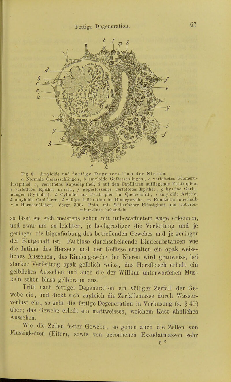 Fig. 8. Amyloide und fettige Degeneration der Nieren. a Normale Gef'ässschlingen, b amyloide Gefässschlingen , c verfettetes Glomeru- Iüsepitkel, verfettetes Kapselepithel, d auf den Capillaren aufliegende Fetttropfen, e verfettetes Epithel in situ , / abgestossenes verfettetes Epithel , g hyaline Gerin- nungen (Cylinder), h Cyliuder aus Fetttropfen im Querschnitt, i amyloide Arterie, h amyloide Capillaren, l zellige Infiltration im Bindegewebe, m Rundzelle innerhalb von Harncanälchen. Vergr. 300. Pra'p mit Müller'scher Flüssigkeit und Ueberos- miumsäure behandelt. so lässt sie sich meistens schon mit unbewaffnetem Auge erkennen, und zwar um so leichter, je hochgradiger die Verfettung und je geringer die Eigenfärbung des betreffenden Gewebes und je geringer der Blutgehalt ist. Farblose durchscheinende Bindesubstanzen wie die Intima des Herzens und der Gefässe erhalten ein opak weiss- liches Aussehen, das Rindengewebe der Nieren wird grauweiss, bei starker Verfettung opak gelblich weiss, das Herzfleisch erhält ein gelbliches Aussehen und auch die der Willkür unterworfenen Mus- keln sehen blass gelbbraun aus. Tritt nach fettiger Degeneration ein völliger Zerfall der Ge- webe ein, und dickt sich zugleich die Zerfallsmasse durch Wasser- verlust ein, so geht die fettige Degeneration in Verkäsung (s. §40) über; das Gewebe erhält ein mattweisses, weichem Käse ähnliches Aussehen. Wie die Zellen fester Gewebe, so gehen auch die Zellen von Flüssigkeiten (Eiter), sowie von geronnenen Exsudatmassen sehr 5*