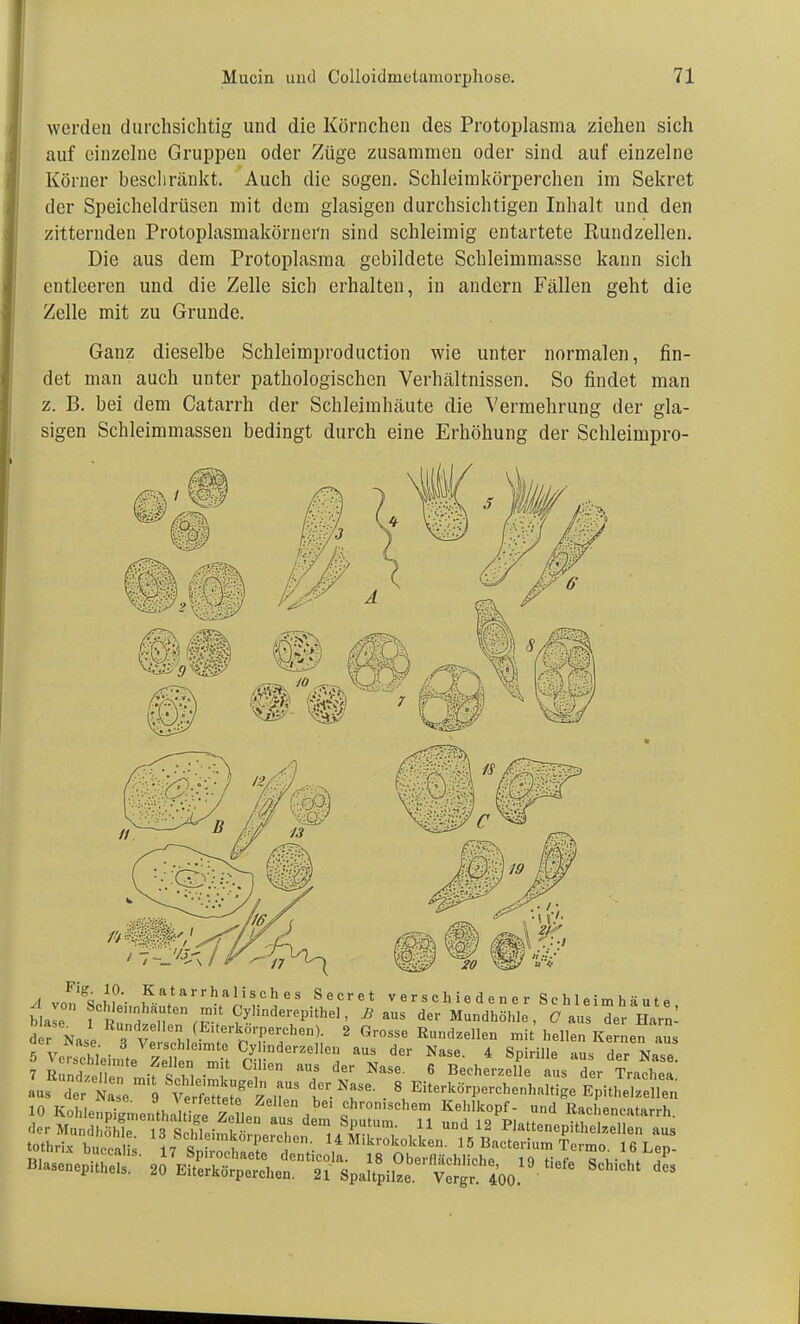 werden durchsichtig und die Körnchen des Protoplasma ziehen sich auf einzelne Gruppen oder Züge zusammen oder sind auf einzelne Körner beschränkt. Auch die sogen. Schleimkörperchen im Sekret der Speicheldrüsen mit dem glasigen durchsichtigen Inhalt und den zitternden Protoplasmakörnei'n sind schleimig entartete Rundzellen. Die aus dem Protoplasma gebildete Schleimmasse kann sich entleeren und die Zelle sieb erhalten, iu andern Fällen geht die Zelle mit zu Grunde. Ganz dieselbe Schleimproduction wie unter normalen, fin- det man auch unter pathologischen Verhältnissen. So findet man z. B. bei dem Catarrh der Schleimhäute die Vermehrung der gla- sigen Schleimmassen bedingt durch eine Erhöhung der Schleimpro- -dvon SnJi - ^aftarrhalisches Secret verschiedener Schleimhäute lle f h!^ » 6n ^'Cy'inderepithel, B aus der Mundhöhle, C aus der Harn- der Nase TvS, fn??161' 2 Gr°SSe Rund^llen mit hellen Kernen aus aer nase. 3 Verschleimte Cylinderzellen aus der Nase 4 Smnlle au« rW TvrJcl 10 Kohlenpfemo„thaltiM 9iu» , Ochromschem Kehlkopf- und Kachencatarrh. uuLcans. ii hpiiochaeto dentico a. 18 Obeiflächlirlip 1Q tiof„ o u- tl j Blasenep.thels. 20 Eiterkörperchen. 21 Spaltpilze Vert 400 Sch>^tdes