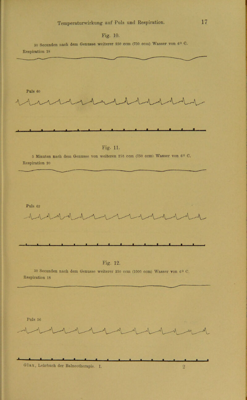 Fig. 10. so Secnnden nach dem Genüsse weiterer 250 com (750 ccm) Wasser von 6<> C. Respiration 18 Puls 60 mm. .mMmmmmmmmam Fig. 11. 5 Minuten nach dem Genüsse von weiteren 250 ccm (750 ccm) Wasser von 6 0 C. Respiration 20 1 « ■ ■ « ■ ■ « « « i.i i ■ ■ I Fig. 12. 30 Secnnden nach dem Genüsse weiterer 250 ccm (1000 ccm) Wasser von 6® C. Respiration 18 61 ax, Lehrbuch der Balneotherapie I 9 } 1 I