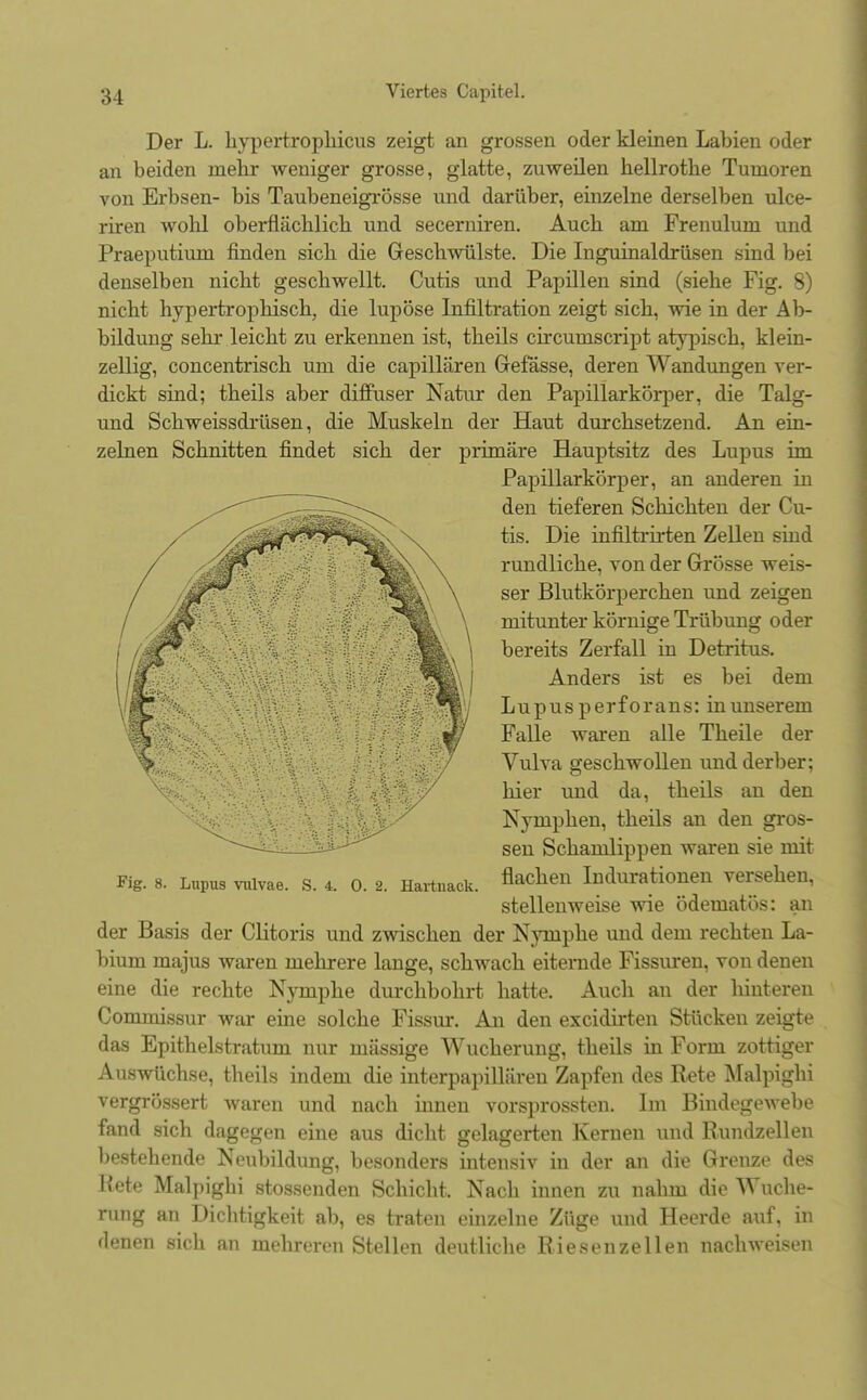 Der L. hypertrophicus zeigt an grossen oder kleinen Labien oder an beiden mehr weniger grosse, glatte, zuweilen hellrothe Tumoren von Erbsen- bis Taubeneigrösse und darüber, einzelne derselben ulce- riren wohl oberflächlich und secerniren. Auch am Frenulum und Praeputium finden sich die Geschwülste. Die Inguinaldrüsen sind bei denselben nicht geschwellt. Cutis und Papillen sind (siehe Fig. 8) nicht hypertrophisch, die lupöse Infiltration zeigt sich, wie in der Ab- bildung sehr leicht zu erkennen ist, theils circumscript atypisch, klein- zellig, concentrisch um die capillären Gefässe, deren Wandungen ver- dickt sind; theils aber diffuser Natur den Papillärkörper, die Talg- und Schweissdrüsen, die Muskeln der Haut durchsetzend. An ein- zelnen Schnitten findet sich der primäre Hauptsitz des Lupus im Papillarkörper, an anderen in den tieferen Schichten der Cu- tis. Die infiltrirten Zellen sind rundliche, von der Grösse weis- ser Blutkörperchen und zeigen mitunter körnige Trübung oder bereits Zerfall in Detritus. Anders ist es bei dem Lupus perforans: in unserem Falle waren alle Theile der Vulva geschwollen und derber; hier und da, theils an den Nymphen, theils an den gros- sen Schamlippen waren sie mit Fig. 8. LupUS vulvae, s. 4. o. 2. Hartnack. flaCüen Indurationen versehen, stellenweise wie ödematös: an der Basis der Clitoris und zwischen der Nymphe und dem rechten La- bium majus waren mehrere lange, schwach eiternde Fissuren, von denen eine die rechte Nymphe durchbohrt hatte. Auch an der hinteren Cominissur war eine solche Fissur. An den excidirten Stücken zeigte das Epithelstratum nur mässige Wucherung, theils in Form zottiger Auswüchse, theils indem die interpapillären Zapfen des Rete Malpighi vergrössert waren und nach innen vorsprossten. Im Bindegewebe fand sich dagegen eine aus dicht gelagerten Kernen und Rundzellen bestehende Neubildung, besonders intensiv in der an die Grenze des Kote Malpighi stossenden Schicht, Nach innen zu nahm die Wuche- rung an Dichtigkeit ab, es traten einzelne Züge und Heerde auf, in denen sich an mehreren Stellen deutliche Rie.senzellen nachweisen