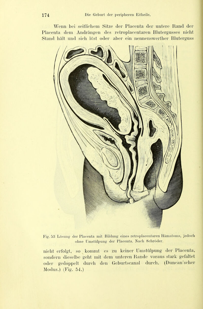 Wenn bei seitlichem Sitze der Placenta der untere Rand der Placenta dem Andrängen des retroplacentaren Blutergusses nicht Stand hält und sich löst oder aber ein nennenswerther Bluterguss Fig. 53 Lösung der Placenta mit Bildung eines retroplacentaren Hämatoms, jedoch ohne Umstülpung der Placenta. Nach Schröder. nicht erfolgt, so kommt es zu keiner Umstülpung der Placenta, sondern dieselbe geht mit dem unteren Rande voraus stark gefaltet oder gedoppelt durch den Geburtscanal durch. (Duncan'scher Modus.) (Fig. 54.)