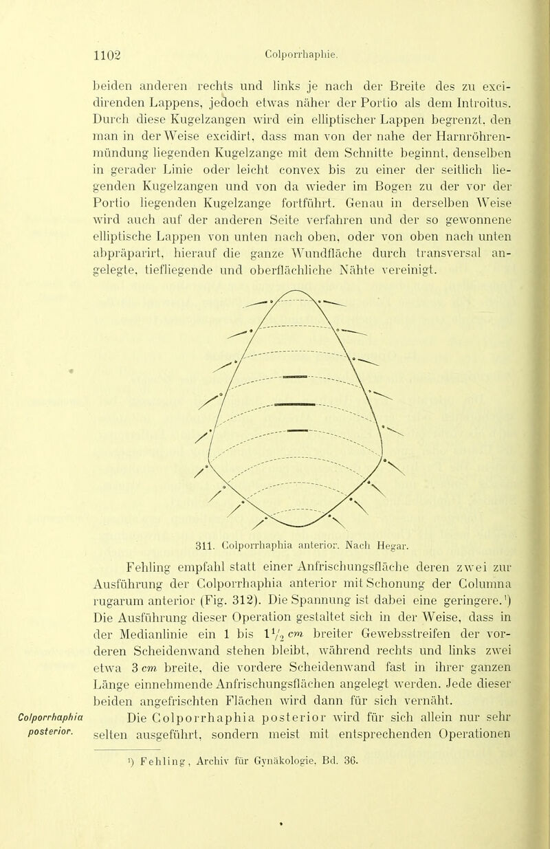 beiden anderen rechts und links je nach der Breite des zu exci- direnden Lappens, jedoch etwas näher der Portio als dem Introitus. Durch diese Kugelzangen wird ein eUiptischer Lappen begrenzt, den man in der Weise excidirt, dass man von der nahe der Harnröhren- mündung liegenden Kugelzange mit dem Schnitte beginnt, denselben in gerader Linie oder leicht convex bis zu einer der seitlich lie- genden Kugelzangen und von da wieder im Bogen zu der vor der Portio liegenden Kugelzange fortführt. Genau in derselben Weise wird auch auf der anderen Seite verfahren und der so gewonnene elliptische Lappen von unten nach oben, oder von oben nach unten abpräparirt, hierauf die ganze Wundfläche durch transversal an- gelegte, tiefliegende und oberflächliche Nähte vereinigt. 311. (lolporrhaphia anterior. Nacli Hegar. Fehling empfahl statt einer Anfrischungsfläche deren zwei zur Ausführung der Golporrhaphia anterior mit Schonung der Golumna rugarum anterior (Fig. 312). Die Spannung ist dabei eine geringere.') Die Ausführung dieser Operation gestaltet sich in der Weise, dass in der Medianlinie ein 1 bis l^/.jcm. breiter Gewebsstreifen der vor- deren Scheidenwand stehen bleibt, während rechts und hnks zwei etwa 3 cm breite, die vordere Scheidenwand fast in ihrer ganzen Länge einnehmende Anfrischungsflächen angelegt Averden. Jede dieser beiden angefrischten Flächen Avird dann für sich vernäht. Coiporrhaphia Die Golporrhaphia posterior wird für sich allein nur sehr posterior. gelten ausgeführt, sondern meist mit entsprechenden Operationen 1) Fehling, Archiv für Gynäkologie, Bd. 36.