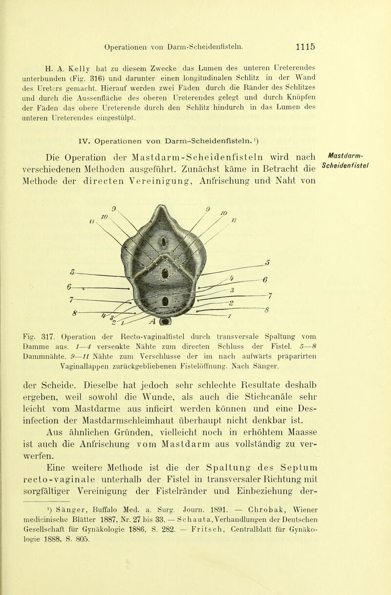 H. A. Kelly hat zu diesem Zwecke das Lumen des unteren üreterendes unterbunden (Fig. 316) und darunter einen longitudinalen Schlitz in der Wand des Ureters gemacht. Hierauf werden zwei Fäden durch die Ränder des Schützes und durch die Aussenfläche des oberen üreterendes gelegt und durch Knüpfen der Fäden das obere Ureterende durch den Schlitz hindurch in das Lumen des unteren Üreterendes eingestülpt. IV. Operationen von Darm-Scheidenfisteln.') Die Operation der Mastdarm-Scheidenfisteln wird nach Mastdarm- verschiedenen Methoden ausgeführt. Zunächst käme in Betracht die ScheidenfisU Methode der directen Vereinigung, Anfrischung und Naht von Fig. 317. Operation der Recto-vaginalfistel durch transversale Spaltung vom Damme aus. /—4 versenkte Nähte zum directen Schluss der Fistel. 5—8 Dammnähte. .9—// Nähte zum Verschlusse der im nach aufwärts präparirten Vaginallappen zurückgebliebenen Fistelöffnung. Nach Sänger. der Scheide. Dieselbe hat jedoch sehr schlechte Resultate deshalb ergeben, weil sowohl die Wunde, als auch die Stichcanäle sehr leicht vom Mastdarme aus inficirt werden können und eine Des- infection der Mastdarmschleimhaut überhaupt nicht denkbar ist. Aus ähnlichen Gründen, vielleicht noch in erhöhtem Maasse ist auch die Anfrischung vom Mastdarm aus vollständig zu ver- werfen. Eine weitere Methode ist die der Spaltung des Septum recto-vaginale unterhalb der Fistel in transversaler Richtung mit sorgfältiger Vereinigung der Fistelränder und Einbeziehung der- ') Sänger, Buffalo Med. a. Surg. Journ. 1891. — Chrobak, Wiener medicinische Blätter 1887, Nr. 27 bis 33. — S chauta, Verhandlungen der Deutschen Gesellschaft für Gynäkologie 1886, S. 282. - Fritsch, Centralblatt für Gynäko- logie 1888, S. 805.