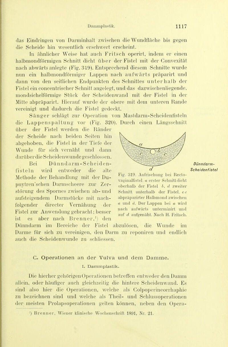 das Eindringen von Darminhalt zwischen die Wundfläche bis gegen die Scheide hin wesentlich erschwert erscheint. In ähnlicher Weise hat auch Fritsch operirt, indem er einen halbmondförmigen Schnitt dicht über der Fistel mit der Gonvexität nach abwärts anlegte (Fig. 319). Entsprechend diesem Schnitte wurde nun ein halbmondförmiger Lappen nach aufwärts präparirt und dann von den seithchen Endpunkten des Schnittes unterhalb der Fistel ein concentrischer Schnitt angelegt, und das dazwischenliegende, mondsichelförmige Stück der Scheidenwand mit der Fistel in der Mitte abpräparirt. Hierauf wurde der obere mit dem unteren Rande vereinigt und dadurch die Fistel gedeckt. Sänger schlägt zur Operation von Mastdarm-Scheidenfisteln die Lappenspaltung vor (Fig. 320). Durch einen Längsschnitt über der Fistel werden die Ränder der Scheide nach beiden Seiten hin abgehoben, die Fistel in der Tiefe der Wunde für sich vernäht und dann darüber die Scheidenwunde geschlossen. Rei Dünndarm-Scheiden- fisteln wird entweder die alte Methode der Behandlung mit der Du- puytren'schen Darmscheere zur Zer- störung des Spornes zwischen ab- und aufsteigendem Darmstücke mit nach- folgender directer Vernähung der Fistel zur Anwendung gebracht; besser ist es aber nach Brenner,') den Dünndarm im Bereiche der Fistel abzulösen, die Wunde im Darme für sich zu vereinigen, den Darm zu reponiren und endlich auch die Scheidenwunde zu schliessen. C. Operationen an der Vulva und dem Damme. I, Dammplastik, Die hierher gehörigen Operationen betreffen entweder den Damm allein, oder häufiger auch gleichzeitig die hintere Scheidenwand. Es sind also hier die Operationen, welche als Golpoperineorrhaphie zu bezeichnen sind und welche als Theil- und Schlussoperationen der meisten Prolapsoperationen gelten können, neben den Opera- ') Brenner, Wiener klinisclie Wochenschrift 1891, Nr. 21. Dünndarm- d Scheidenfistel Fig. 319. Anfrischung tjei Recto- vaginalfistel. a erster Schnitt dicht oberhalb der Fistel 1. d zweiter Schnitt unterhalb der Fistel, c o abpräpai-irter Halbmond zwischen a und d. Der Lappen bei a wird nacli aufwärts unterminirt und auf d aufgenäht. Nach H. Fritsch.