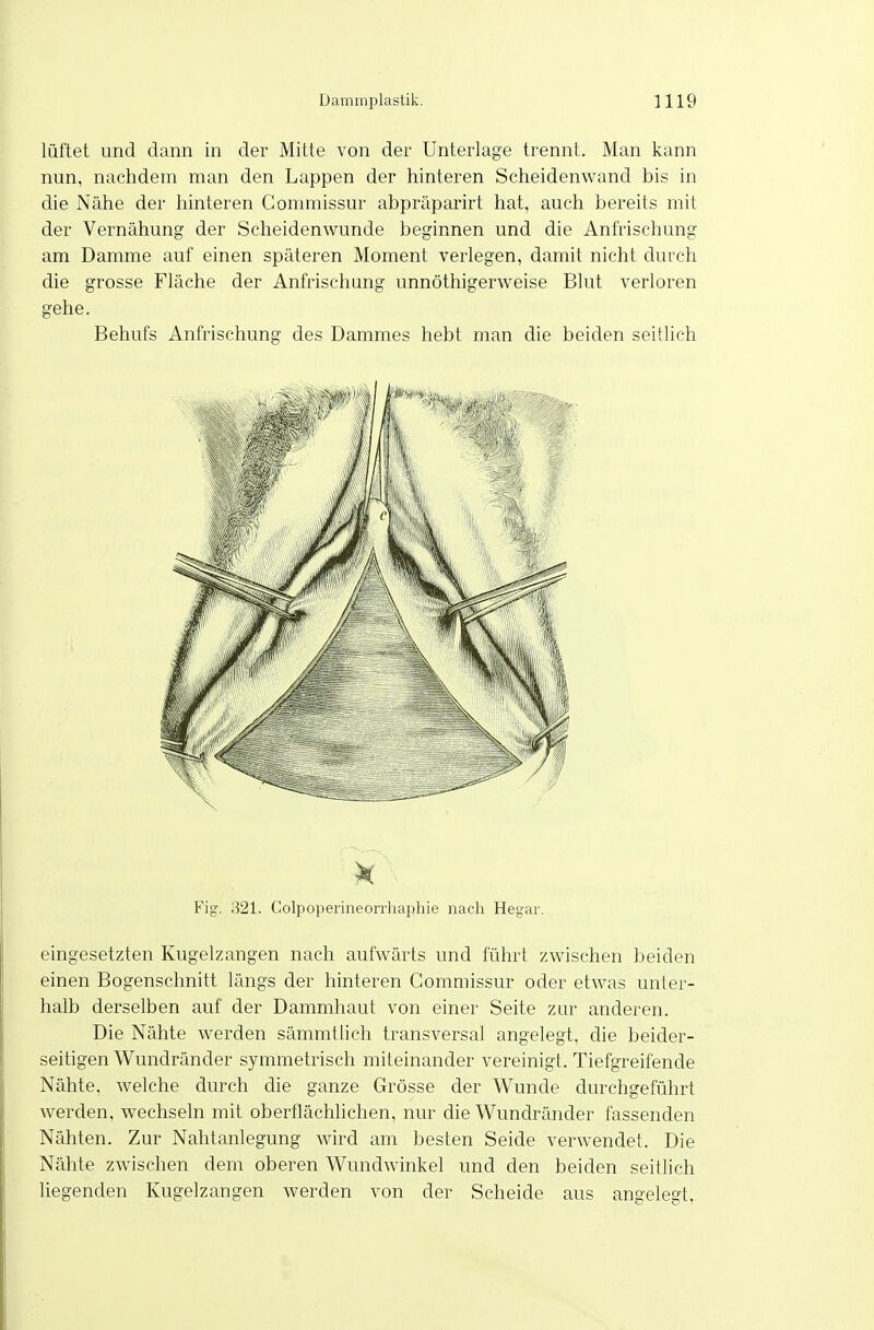 lüftet und dann in der Mitte von der Unterlage trennt. Man kann nun, nachdem man den Lappen der hinteren Scheidenwand bis in die Nähe der hinteren Commissur abpräparirt hat, auch bereits mit der Vernähung der Scheidenwunde beginnen und die Anfrischung am Damme auf einen späteren Moment verlegen, damit nicht durch die grosse Fläche der Anfrischung unnöthigerweise Blut verloren gehe. Behufs Anfrischung des Dammes hebt man die beiden seitlich Fig. 321. Colpoperineorrliaphie nach Hegar. eingesetzten Kugelzangen nach aufwärts und führt zwischen beiden einen Bogenschnitt längs der hinteren Commissur oder etwas unter- halb derselben auf der Dammhaut von einer Seite zur anderen. Die Nähte werden sämmtlich transversal angelegt, die beider- seitigen Wundränder symmetrisch miteinander vereinigt. Tiefgreifende Nähte, welche durch die ganze Grösse der Wunde durchgeführt werden, wechseln mit oberflächlichen, nur die Wundränder fassenden Nähten. Zur Nahtanlegung wird am besten Seide verwendet. Die Nähte zwischen dem oberen Wundwinkel und den beiden seitlich liegenden Kugelzangen werden von der Scheide aus angelegt,