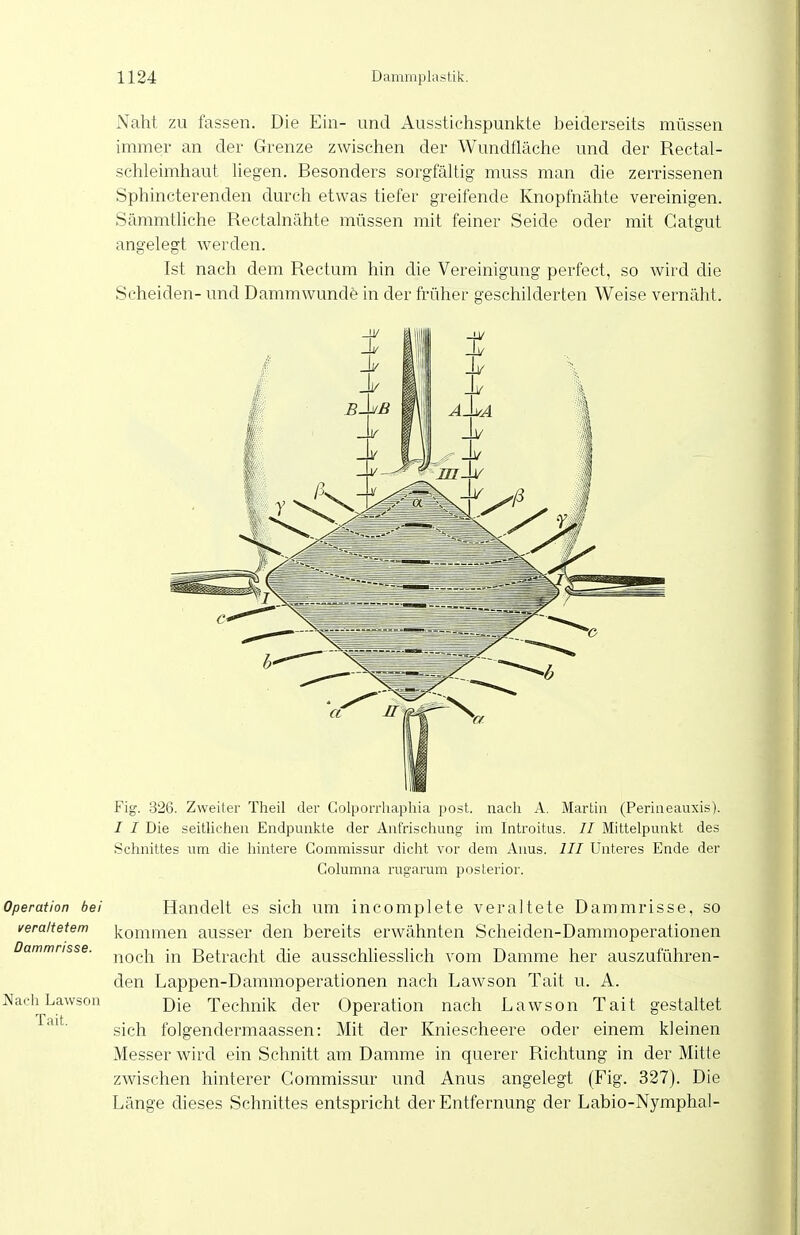 Naht zu fassen. Die Ein- und Ausstichspunkte beiderseits müssen immer an der Grenze zwischen der Wundfläche und der Rectal- schleimhaut liegen. Besonders sorgfältig muss man die zerrissenen Sphincterenden durch etwas tiefer greifende Knopfnähte vereinigen. Sämmtliche Rectalnähte müssen mit feiner Seide oder mit Gatgut angelegt werden. Ist nach dem Rectum hin die Vereinigung perfect, so wird die Scheiden- und Dammwunde in der früher geschilderten Weise vernäht. Operation bei veraiietem Dammrisse. Nach Lawson Tait. Fig. 326. Zweiter Theil der Golporrhapliia post nacli A. Martin (Periiieauxis). / I Die seitlichen Endpunkte der Anfrischung im Introitus. II Mittelpunkt des Schnittes um die hintere Commissur dicht vor dem Anus. III Unteres Ende der Columna rugarum posterior. Handelt es sich um incomplete veraltete Dammrisse, so kommen ausser den bereits erwähnten Scheiden-Dammoperationen noch in Betracht die ausschliesslich vom Damme her auszuführen- den Lappen-Dammoperationen nach Lawson Tait u. A. Die Technik der Operation nach Lawson Tait gestaltet sich folgendermaassen: Mit der Kniescheere oder einem kleinen Messer wird ein Schnitt am Damme in querer Richtung in der Mitte zwischen hinterer Commissur und Anus angelegt (Fig. 327). Die Länge dieses Schnittes entspricht der Entfernung der Labio-Nymphal-