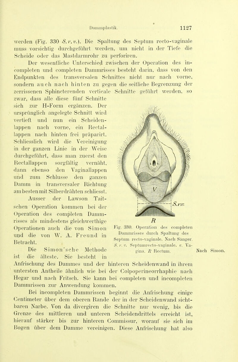 werden (Fig. 330 S.r.v.). Die Spaltung des Septum recto-vaginale muss vorsichtig durchgeführt werden, um nicht in der Tiefe die Scheide oder das Mastdarmrohr zu perforiren. Der wesenthche Unterschied zwischen der Operation des in- completen und completen Dammrisses besteht darin, dass von den Endpunkten des transversalen Schnittes nicht nur nach vorne, sondern auch nach hinten zu gegen die seitliche Begrenzung der zerrissenen Sphincterenden verticale Schnitte geführt werden, so zwar, dass alle diese fünf Schnitte sich zur H-Form ergänzen. Der ursprünglich angelegte Schnitt wird vertieft und nun ein Scheiden- lappen nach vorne, ein Rectal- lappen nach hinten frei präparirt. Schliesslich wird die Vereinigung in der ganzen Linie in der Weise durchgeführt, dass man zuerst den Rectallappen sorgfältig vernäht, dann ebenso den Vaginallappen und zum Schlüsse den ganzen Damm in transversaler Richtung ambestenmit Silberdrähten schliesst. Ausser der Lawson Tait- schen Operation kommen bei der Operation des completen Damm- risses als mindestens gleichwerthige Operationen auch die von Simon uijd die von W. A. Freund in Betracht. Die Simon's che Methode ist die älteste. Sie besteht in Anfrischung des Dammes und der hinteren Scheidenwand in ihrem untersten Antheile ähnlich wie bei der Colpoperineorrhaphie nach Hegar und nach Fritsch. Sie kann bei completen und incompleten Dammrissen zur Anwendung kommen. Bei incompleten Dammrissen beginnt die Anfrischung einige Gentimeter über dem oberen Rande der in der Scheidenwand sicht- baren Narbe. Von da divergiren die Schnitte nur Avenig, bis die Grenze des mittleren und unteren Scheidendrittels erreicht ist, hierauf stärker bis zur hinteren Gommissur, worauf sie sich im Bogen über dem Damme vereinigen. Diese Anfrischung hat also iiii iiiiiiii R Fig. 330. Operation des completen Dammrisses durch Spaltung des Septum recto-vaginale. Nach Sänger. Ä r. V. Septumrecto-vaginale. v. Va- gina. R Rectum. Nach Simon.