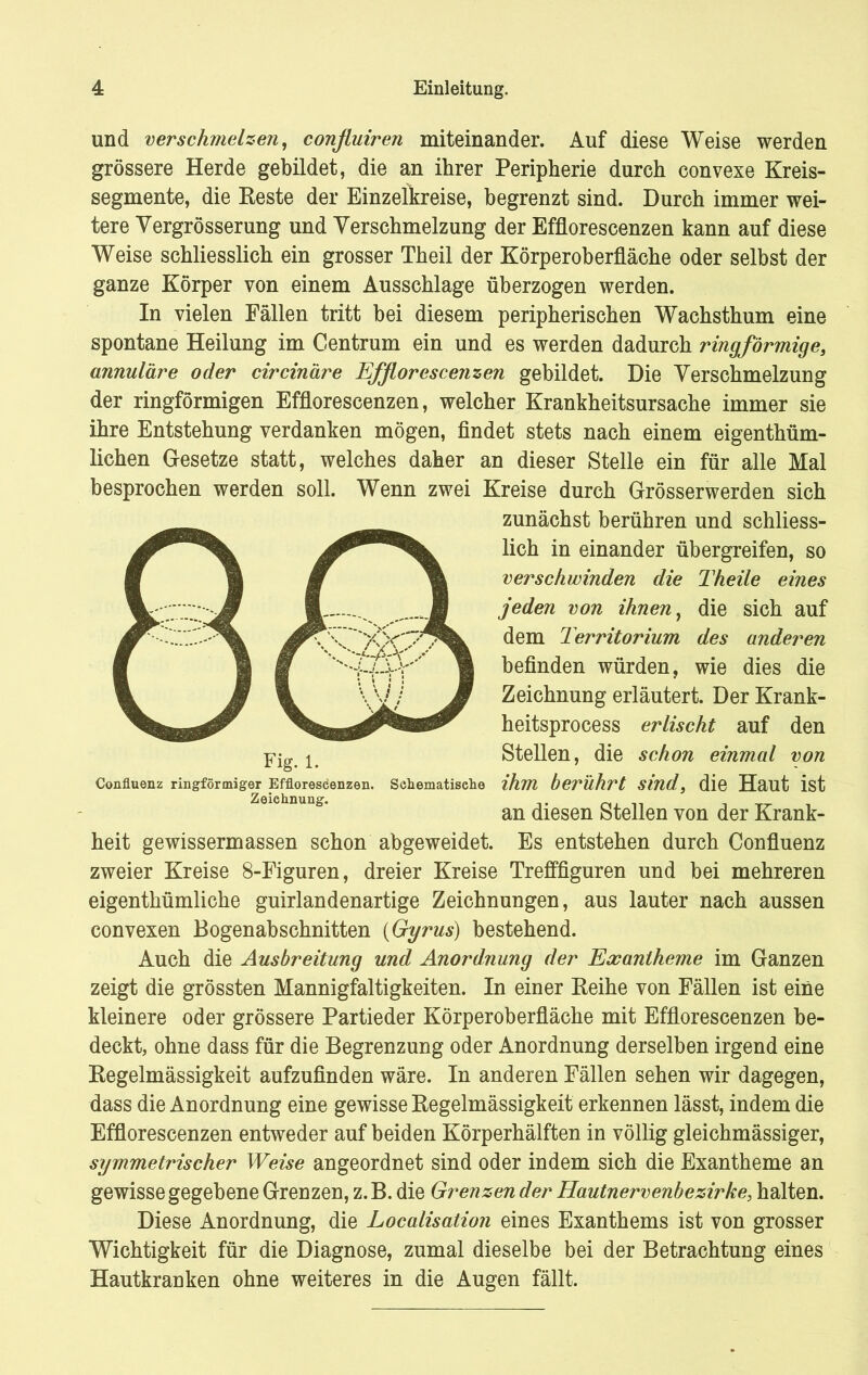 und verschmelzen, confluiren miteinander. Auf diese Weise werden grössere Herde gebildet, die an ihrer Peripherie durch convexe Kreis- segmente, die Beste der Einzeikreise, begrenzt sind. Durch immer wei- tere Yergrösserung und Verschmelzung der Efflorescenzen kann auf diese Weise schliesslich ein grosser Theil der Körperoberfläche oder selbst der ganze Körper von einem Ausschlage überzogen werden. In vielen Fällen tritt bei diesem peripherischen Wachsthum eine spontane Heilung im Centrum ein und es werden dadurch ringförmige, annuläre oder circinäre Efflorescenzen gebildet. Die Verschmelzung der ringförmigen Efflorescenzen, welcher Krankheitsursache immer sie ihre Entstehung verdanken mögen, findet stets nach einem eigentüm- lichen Gesetze statt, welches daher an dieser Stelle ein für alle Mal besprochen werden soll. Wenn zwei Kreise durch Grösserwerden sich zunächst berühren und schliess- lich in einander übergreifen, so verschwinden die Theile eines jeden von ihnen, die sich auf dem Territorium des anderen befinden würden, wie dies die Zeichnung erläutert. Der Krank- heitsprocess erlischt auf den Stellen, die schon einmal von schematische ihm berührt sind, die Haut ist an diesen Stellen von der Krank- heit gewissermassen schon abgeweidet. Es entstehen durch Confluenz zweier Kreise 8-Figuren, dreier Kreise Trefffiguren und bei mehreren eigenthümliche guirlandenartige Zeichnungen, aus lauter nach aussen convexen Bogenabschnitten (Gyrus) bestehend. Auch die Ausbreitung und Anordnung der Exantheme im Ganzen zeigt die grössten Mannigfaltigkeiten. In einer Keihe von Fällen ist eine kleinere oder grössere Partieder Körperoberfläche mit Efflorescenzen be- deckt, ohne dass für die Begrenzung oder Anordnung derselben irgend eine Regelmässigkeit aufzufinden wäre. In anderen Fällen sehen wir dagegen, dass die Anordnung eine gewisse Regelmässigkeit erkennen lässt, indem die Efflorescenzen entweder auf beiden Körperhälften in völlig gleichmässiger, symmetrischer Weise angeordnet sind oder indem sich die Exantheme an gewisse gegebene Grenzen, z.B. die Grenzen der Hautnervenbezirke, halten. Diese Anordnung, die Localisation eines Exanthems ist von grosser Wichtigkeit für die Diagnose, zumal dieselbe bei der Betrachtung eines Hautkranken ohne weiteres in die Augen fällt. Fig. 1. Confluenz ringförmiger Efflorescenzen. Zeichnung.