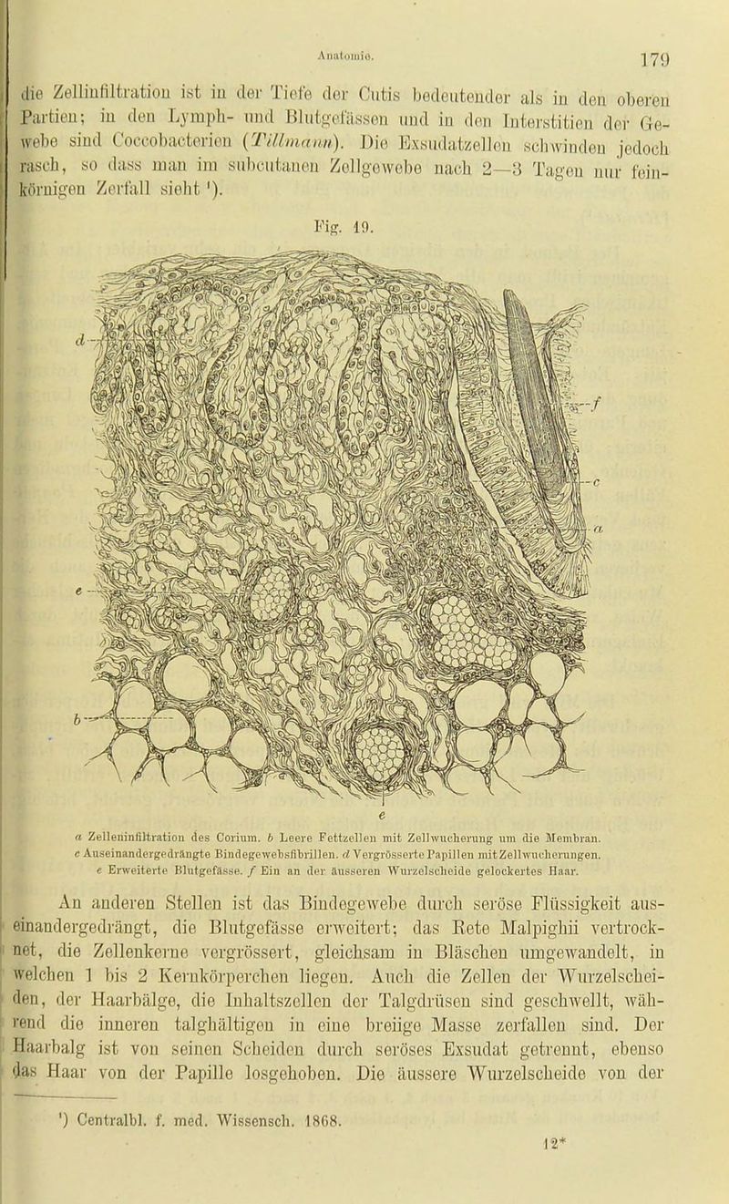 ,tie ZelliuHltnitiou ist iu der Tiefe der Cutis bedeuteuder als in den oberen l'artieu; iu den Lyrapli- und BlutoelUssen und iu den Intei-.stitien der Ge- wehe sind Coccobacterieu (TiUmaiui). Die Exsudatzellou Kchwiudeu jedoch rasch, so dass mau im subcutaueu Zellgewebe nach 2—3 Tagen nur loin- köruigen Zerfall sieht'). Fi^. 10. e a Zelleninflltration des Corium. b Leere Fettzelleu mit Zelhvucherung um die Membran. c Auseinandergedrängte Bindegewebsfitrillen. d Vergrösserte Papillen mit Zellwucherungen. e EiTveiterte Blutgefässe. / Ein an der äusseren Wurzelsclieide gelockertes Haar. An anderen Stellen ist das Bindegewebe diu'ch seröse Flüssigkeit aus- einandergedrcängt, die Blutgefässe ej'weitert; das Eete Malpighii vertrock- net, die Zellenkorne vergrössert, gleichsam in Bläschen umgewandelt, in welchen 1 bis 2 Kerukörperchen liegen. Auch die Zellen der Wurzelschei- den, der Haarbälge, die Inhaltszellen der Talgdrüsen sind geschAvellt, wäh- rend die inneren talghältigeu in eine breiige Masse zerfallen sind. Der Haarbalg ist von seinen Scheiden durch seröses Exsudat getrennt, ebenso ^as Haar von der Papille losgehoben. Die äussere Wurzelscheide von der ') Centralbl. f. med. Wissensch. 1868. 12*