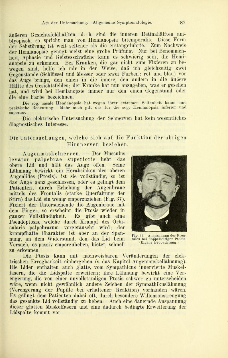 äußeren Gesichtsfeldhälften, d. h. sind die inneren Retinahälften am- blyopisch, so spricht man von Hemianopsia bitemporalis. Diese Form der Sehstörung ist weit seltener als die erstangeführte. Zum Nachweis der Hemianopsie genügt meist eine grobe Prüfung. Nur bei Benommen- heit, Aphasie und Geistesschwäche kann es schwierig sein, die Hemi- anopsie zu erkennen. Bei Kranken, die gar nicht zum Fixieren zu be- wegen sind, helfe ich mir in der Weise, daß ich gleichzeitig zwei Gegenstände (Schlüssel und Messer oder zwei Farben: rot und blau) vor das Auge bringe, den einen in die innere, den andern in die äußere Hälfte des Gesichtsfeldes; der Kranke hat nun anzugeben, was er gesehen hat, und wird bei Hemianopsie immer nur den einen Gegenstand oder die eine Farbe bezeichnen. Die sog. nasale Hemianopsie hat wegen ihrer extremen Seltenheit kaum eine praktische Bedeutung. Mehr noch gilt das für die sog. Hemianopsia inferior und superior. Die elektrische Untersuchung der Sehnerven hat kein wesentliches diagnostisches Interesse. Die Untersuchungen, welche sich auf die Funktion der übrigen Hirnnerven beziehen. Augenmuskelnerven. — Der Musculus levator palpebrae superioris hebt das obere Lid und hält das Auge offen. Seine Lähmung bewirkt ein Herabsinken des oberen Augenlides (Ptosis); ist sie vollständig, so ist das Auge ganz geschlossen, oder es gelingt dem Patienten, durch Erhebung der Augenbraue mittels des Frontalis (starke Querfaltung der Stirn) das Lid ein wenig emporzuziehen (Fig. 37). Fixiert der Untersuchende die Augenbraue mit dem Finger, so erscheint die Ptosis wieder in ganzer Vollständigkeit. Es gibt auch eine Pseudoptosis, welche durch Krampf des Orbi- cularis palpebrarum vorgetäuscht wird; der krampfhafte Charakter ist aber an der Span- nung, an dem Widerstand, den das Lid beim Versuch, es passiv emporzuheben, bietet, schnell zu erkennen. Die Ptosis kann mit nachweisbaren Veränderungen der elek- trischen Erregbarkeit einhergehen (s. das Kapitel Augenmuskellähmung). Die Lider enthalten auch glatte, vom Sympathicus innervierte Muskel- fasern, die die Lidspalte erweitern; ihre Lähmung bewirkt eine Ver- engerung, die von einer unvollständigen Ptosis schwer zu unterscheiden wäre, wenn nicht gewöhnlich andere Zeichen der Sympathikuslähmung (Verengerung der Pupille bei erhaltener Reaktion) vorhanden wären. Es gelingt dem Patienten dabei oft, durch besondere Willensanstrengung das gesenkte Lid vollständig zu heben. Auch eine dauernde Anspannung dieser glatten Muskelfasern und eine dadurch bedingte Erweiterung der Lidspalte kommt vor. Fig. 37. Anspannung der Fron- tales bei doppelseitiger Ptosis. (Eigene Beobachtung.)