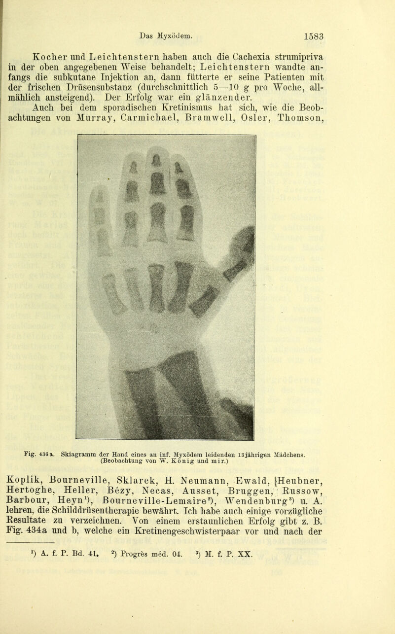 Kocher und Leichtenstern haben auch die Cachexia strumipriva in der oben angegebenen Weise behandelt; Leichtenstern wandte an- fangs die subkutane Injektion an, dann fütterte er seine Patienten mit der frischen Drüsensubstanz (durchschnittlich 5—10 g pro Woche, all- mählich ansteigend). Der Erfolg war ein glänzender. Auch bei dem sporadischen Kretinismus hat sich, wie die Beob- achtungen von Murray, Carmichael, Bramwell, Osler, Thomson, Fig. 436 a. Skiagramm der Hand eines an inf. Myxödem leidenden I3.iährigen Mädchens. (Beobachtung von W. König und mir.) Koplik, Bourneville, Sklarek, H. Neumann, Ewald, |Heubner, Hertoghe, Heller, Bezy, Necas, Ausset, Brüggen, Russow, Barbour, Heyn1), Bourneville-Lemaire2), Wendenburg3) u. A. lehren, die Schilddrüsentherapie bewährt. Ich habe auch einige vorzügliche Resultate zu verzeichnen. Von einem erstaunlichen Erfolg gibt z. B. Fig. 434a und b, welche ein Kretinengeschwisterpaar vor und nach der *) Ä.. f. P. Bd. 41. 2) Progres med. 04. 3) M. f. P. XX.