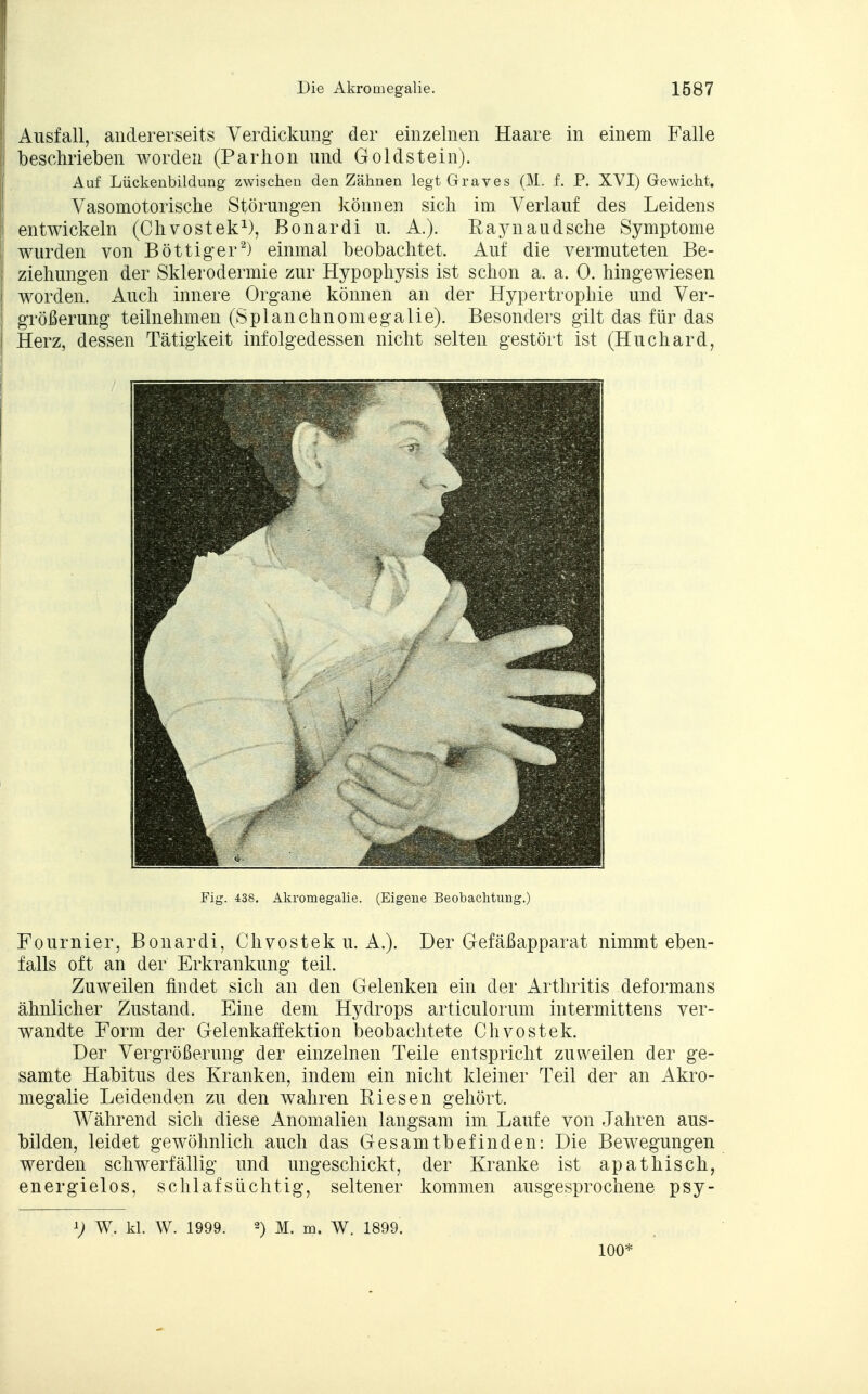 Ausfall, andererseits Verdickung der einzelnen Haare in einem Falle beschrieben worden (Parhon und Goldstein). Auf Lückenbildung zwischen den Zähnen legt Graves (M. f. P. XVI) Gewicht. Vasomotorische Störungen können sich im Verlauf des Leidens entwickeln (Chvostek1), Bonardi u. A.). Eaynaudsche Symptome wurden von Böttiger2) einmal beobachtet. Auf die vermuteten Be- ziehungen der Sklerodermie zur Hypophysis ist schon a. a. 0. hingewiesen worden. Auch innere Organe können an der Hypertrophie und Ver- größerung teilnehmen (Splanchnomegalie). Besonders gilt das für das Herz, dessen Tätigkeit infolgedessen nicht selten gestört ist (Huchard, Fig. 438. Akromegalie. (Eigene Beobachtung.) Fournier, Bonardi, Chvostek u. A.). Der Gefäßapparat nimmt eben- falls oft an der Erkrankung teil. Zuweilen findet sich an den Gelenken ein der Arthritis deformans ähnlicher Zustand. Eine dem Hydrops articulorum intermittens ver- wandte Form der Gelenkaffektion beobachtete Chvostek. Der Vergrößerung der einzelnen Teile entspricht zuweilen der ge- samte Habitus des Kranken, indem ein nicht kleiner Teil der an Akro- megalie Leidenden zu den wahren Kiesen gehört. Während sich diese Anomalien langsam im Laufe von Jahren aus- bilden, leidet gewöhnlich auch das Gesamtbefinden: Die Bewegungen werden schwerfällig und ungeschickt, der Kranke ist apathisch, energielos, schlafsüchtig, seltener kommen ausgesprochene psy- V W. kl. W. 1999. 2) M. m. W. 1899. 100*