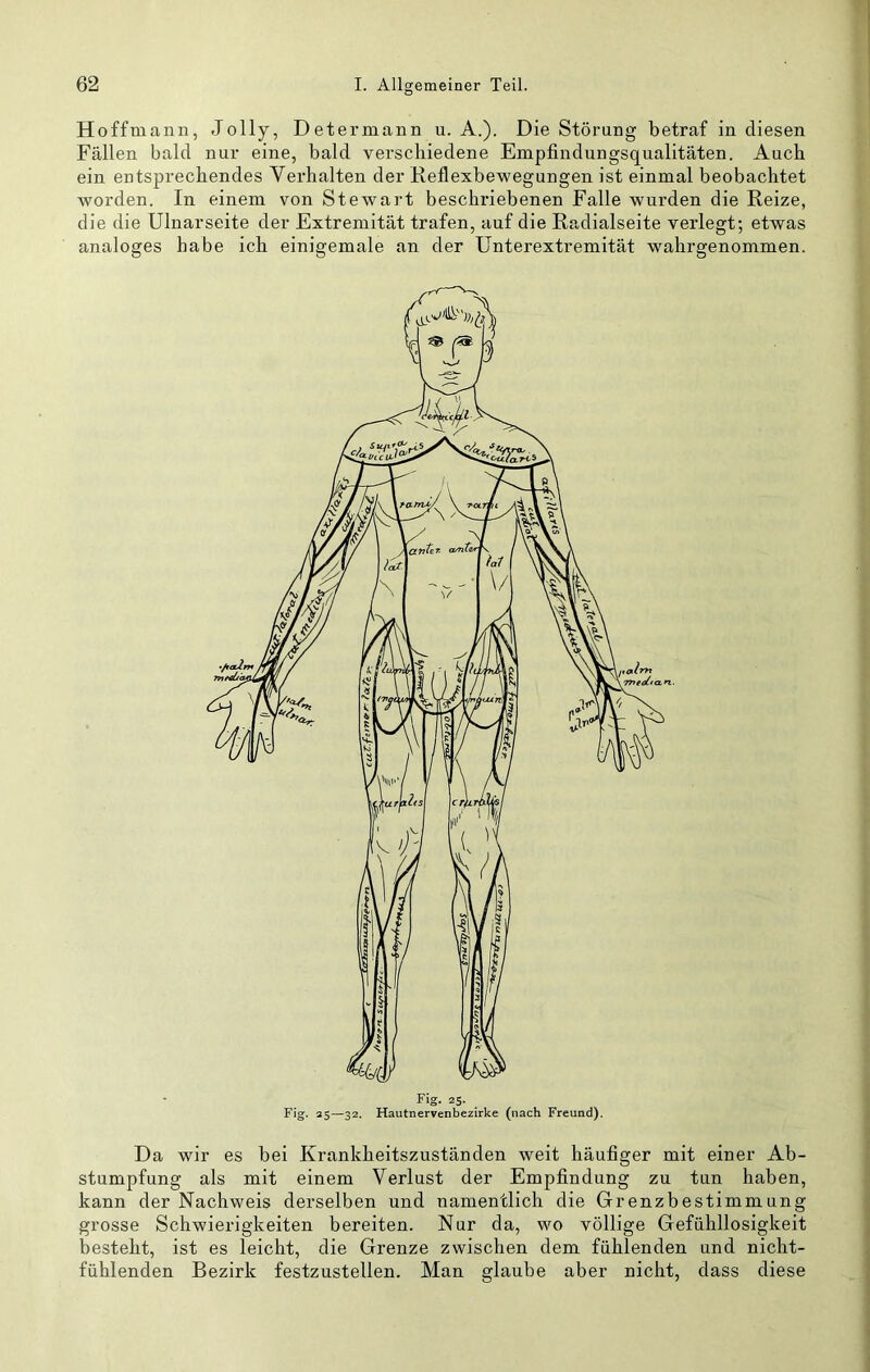 Hoffmanii, Jolly, Determann u. A.). Die Störung betraf in diesen Fällen bald nur eine, bald verschiedene Empfindungsqualitäten. Auch ein entsprechendes Yerhalten der Keflexbewegungen ist einmal beobachtet worden. In einem von Stewart beschriebenen Falle wurden die Reize, die die Ulnarseite der Extremität trafen, auf die Radialseite verlegt; etwas analoges habe ich einigemale an der Unterextremität wahrgenommen. Da wir es bei Krankheitszuständen weit häufiger mit einer Ab- stumpfung als mit einem Verlust der Empfindung zu tun haben, kann der Nachweis derselben und namentlich die Grenzbestimmung grosse Schwierigkeiten bereiten. Nur da, wo völlige Gefühllosigkeit besteht, ist es leicht, die Grenze zwischen dem fühlenden und nicht- fühlenden Bezirk festzustellen. Man glaube aber nicht, dass diese