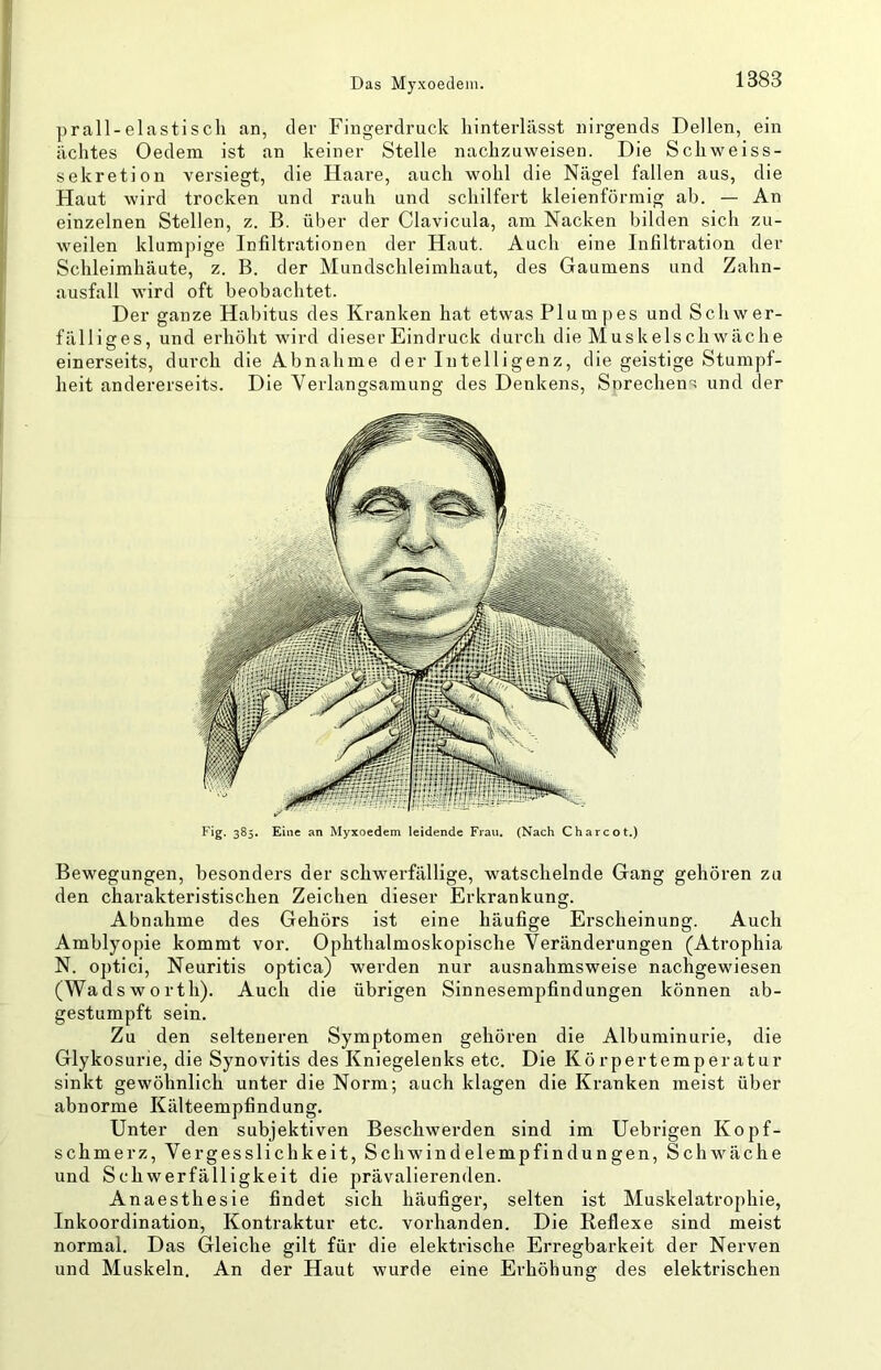 prall-elastiscli an, der Fingerdruck liinterlässt nirgends Dellen, ein achtes Oedem ist an keiner Stelle nachzuweisen. Die Schweiss- sekretion versiegt, die Haare, auch wohl die Nägel fallen aus, die Haut wird trocken und rauh und schilfert kleienförmig ah. — An einzelnen Stellen, z. B. über der Clavicula, am Nacken bilden sich zu- weilen klumpige Infiltrationen der Haut. Auch eine Infiltration der Schleimhäute, z. B. der Mundschleimhaut, des Gaumens und Zahn- ausfall wird oft beobachtet. Der ganze Habitus des Kranken hat etwas Plumpes und Schwer- fälliges, und erhöht wird dieser Eindruck durch die Muskelschwäche einerseits, durch die Abnahme d er Intelligenz, die geistige Stumpf- heit andererseits. Die Yerlangsamung des Denkens, Snrechens und der Fig. 385, Eine an Myxoedem leidende Frau. (Nach Charcot.) Bewegungen, besonders der schwerfällige, watschelnde Gang gehören zu den charakteristischen Zeichen dieser Erkrankung. Abnahme des Gehörs ist eine häufige Erscheinung. Auch Amblyopie kommt vor. Ophthalmoskopische Veränderungen (Atrophia N. optici, Neuritis optica) werden nur ausnahmsweise nachgewiesen (Wadsworth). Auch die übrigen Sinnesempfindungen können ab- gestumpft sein. Zu den selteneren Symptomen gehören die Albuminurie, die Glykosurie, die Synovitis des Kniegelenks etc. Die Körpertemperatur sinkt gewöhnlich unter die Norm; auch klagen die Kranken meist über abnorme Kälteempfindung. Unter den subjektiven Beschwerden sind im Uebrigen Kopf- schmerz, Vergesslichkeit, Schwindelempfindungen, SchwAche und Schwerfälligkeit die prävalierenden. Anaesthesie findet sich häufiger, selten ist Muskelatrophie, Inkoordination, Kontraktur etc. vorhanden. Die Reflexe sind meist normal. Das Gleiche gilt für die elektrische Erregbarkeit der Nerven und Muskeln. An der Haut wurde eine Erhöhung des elektrischen